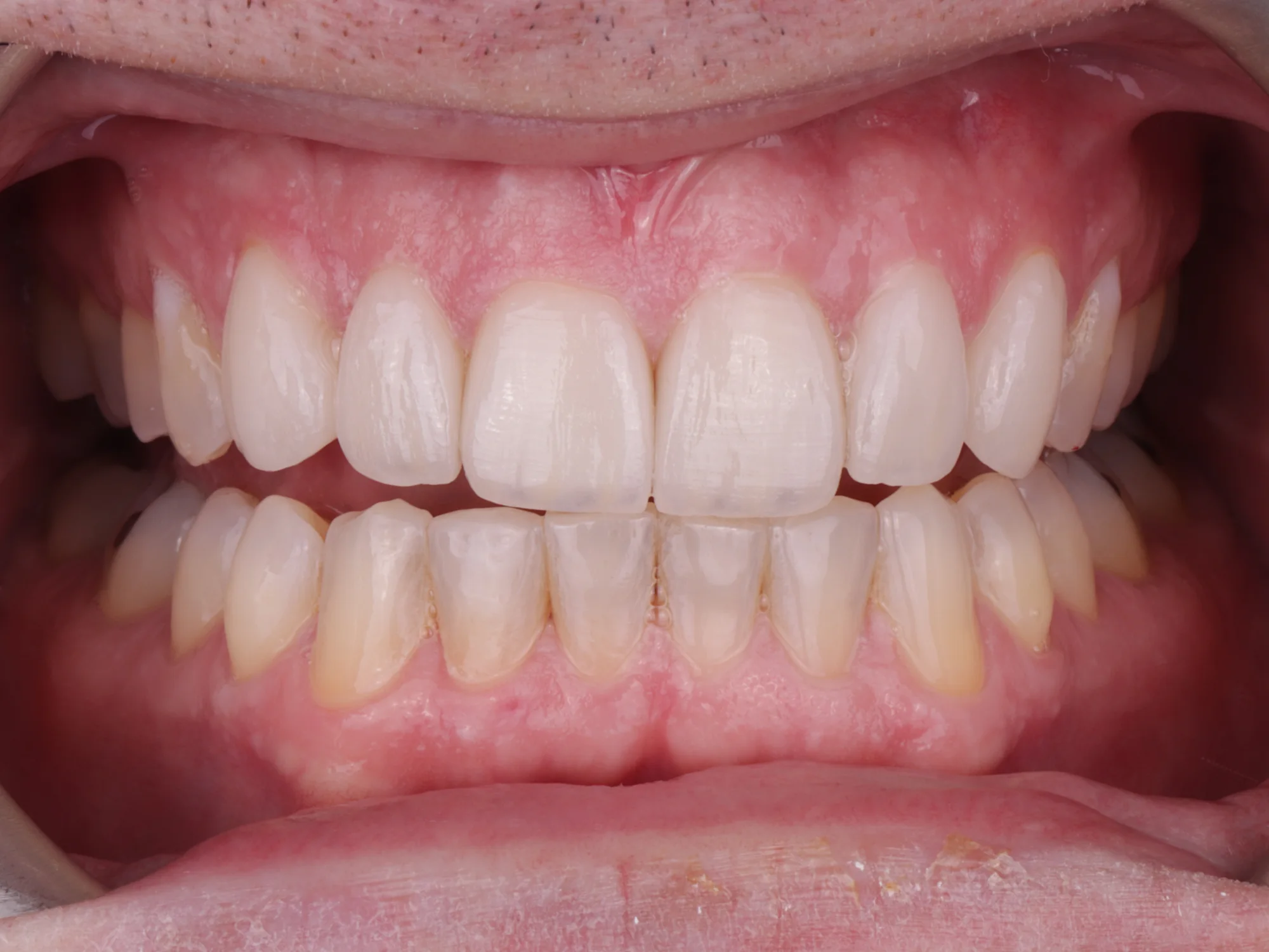 Image of uneven teeth showing misalignment.