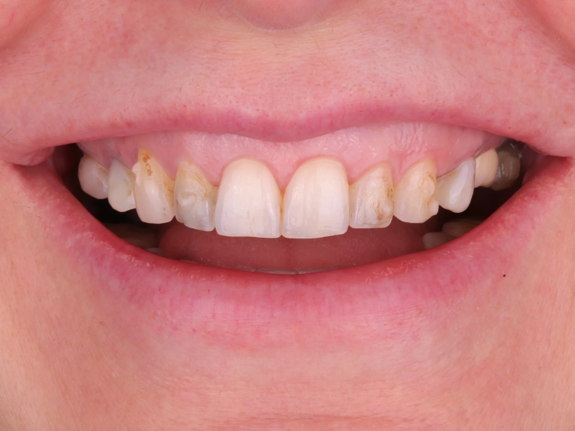 Close-up of discolored and damaged teeth before porcelain veneer treatment