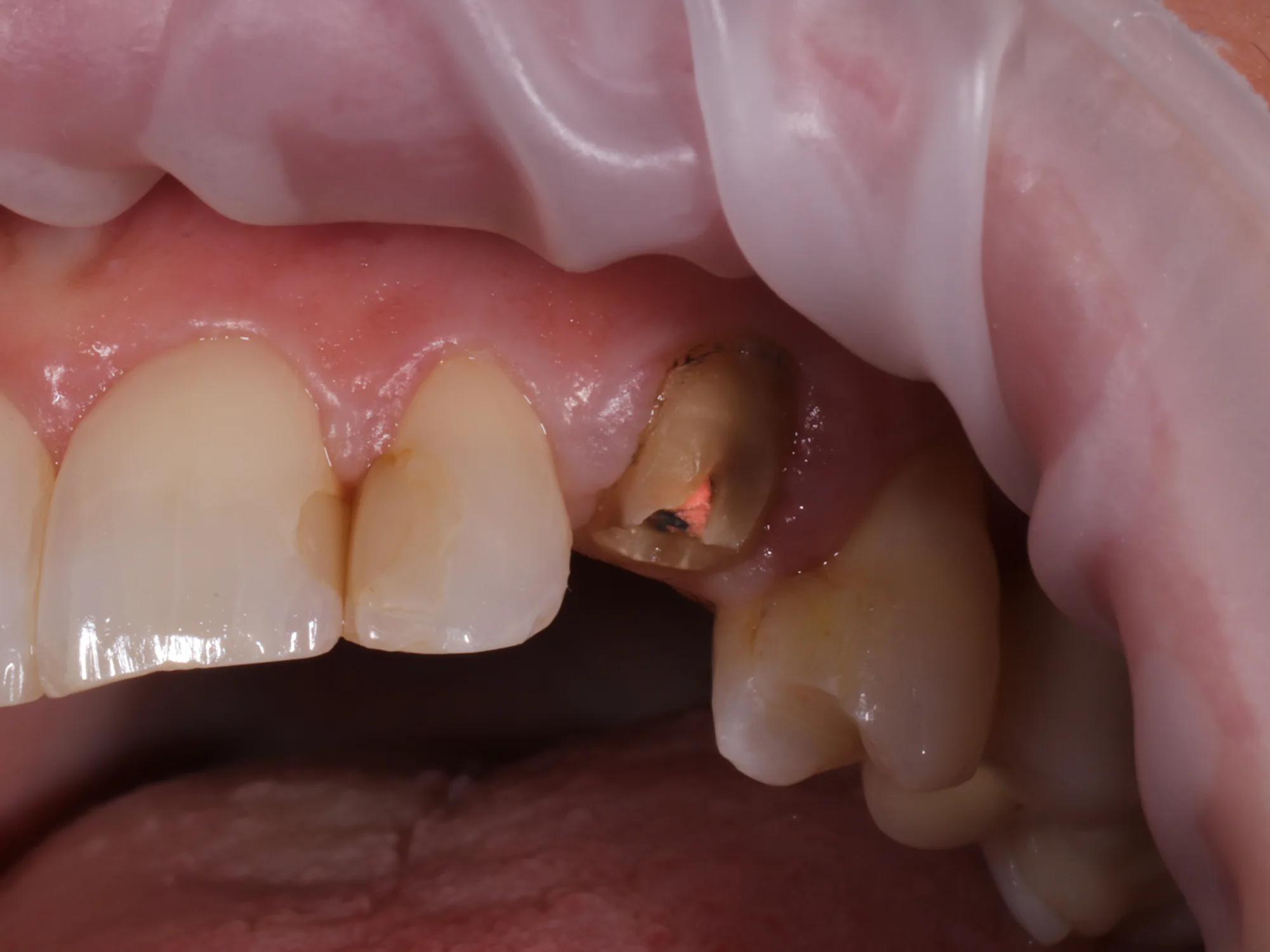 Close-up of a damaged front tooth before treatment