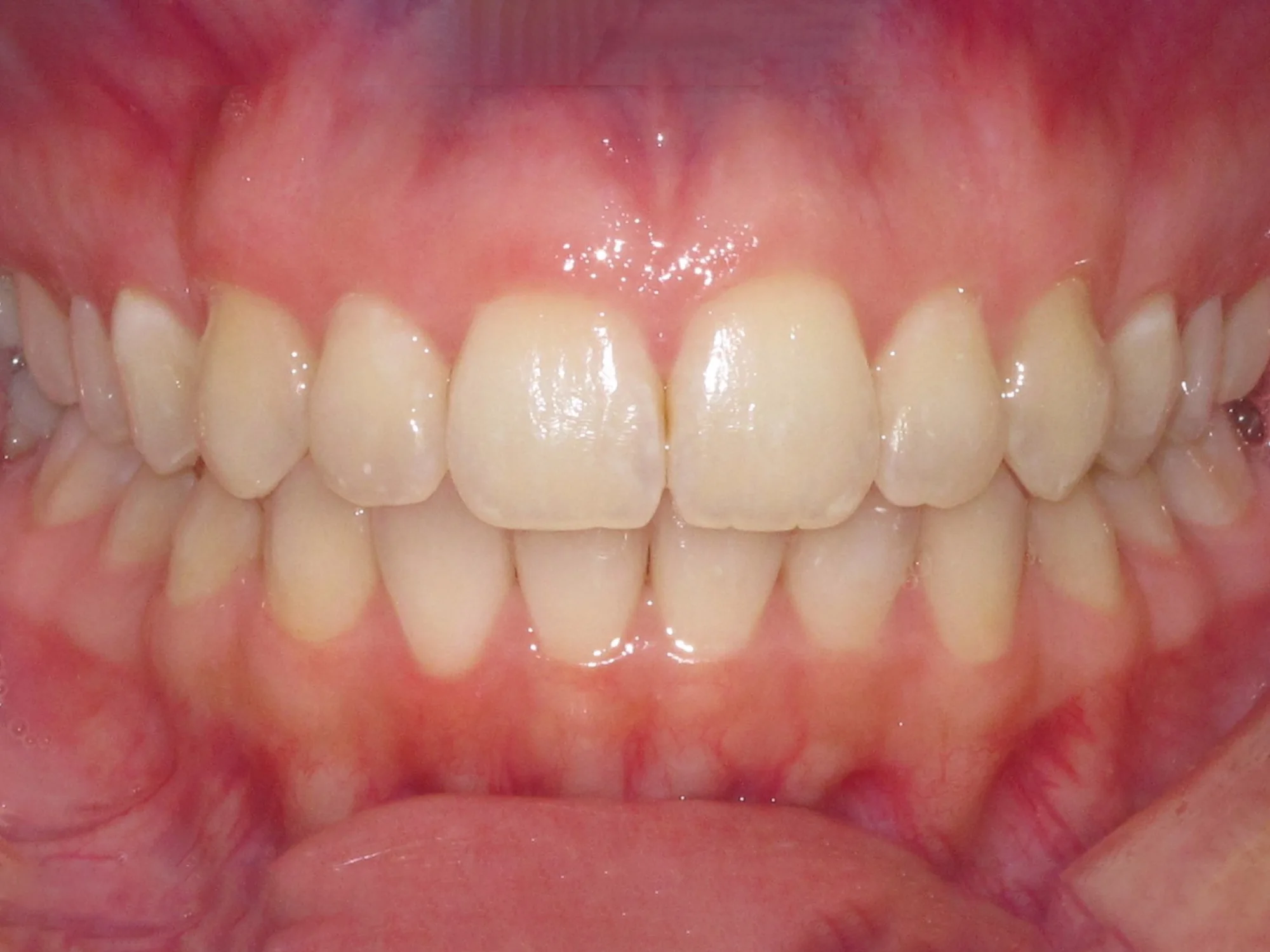 Perfectly aligned front teeth after Invisalign treatment with natural smile appearance