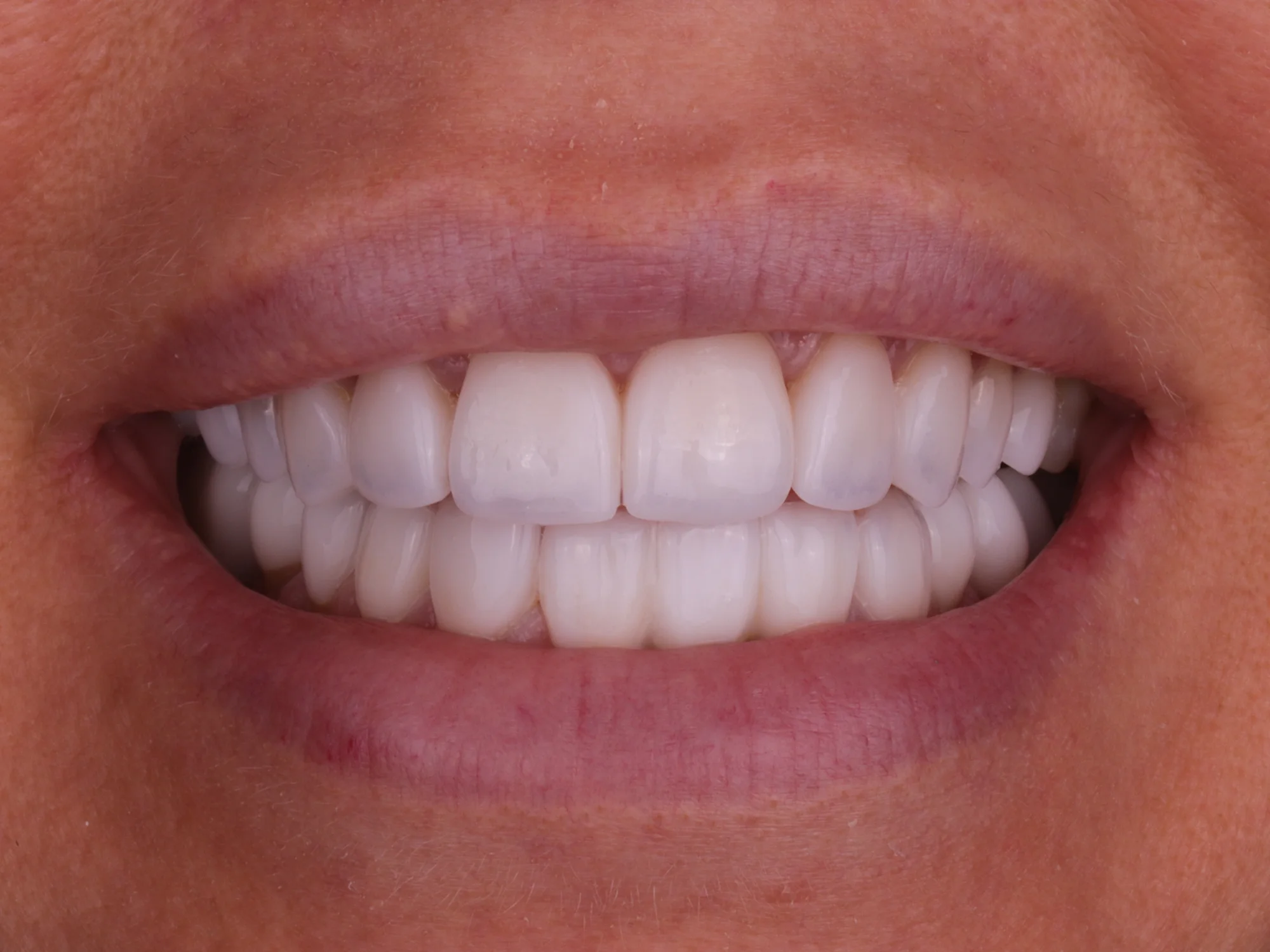 Perfectly aligned, bright smile after veneers at Mississauga Smiles Dentistry.