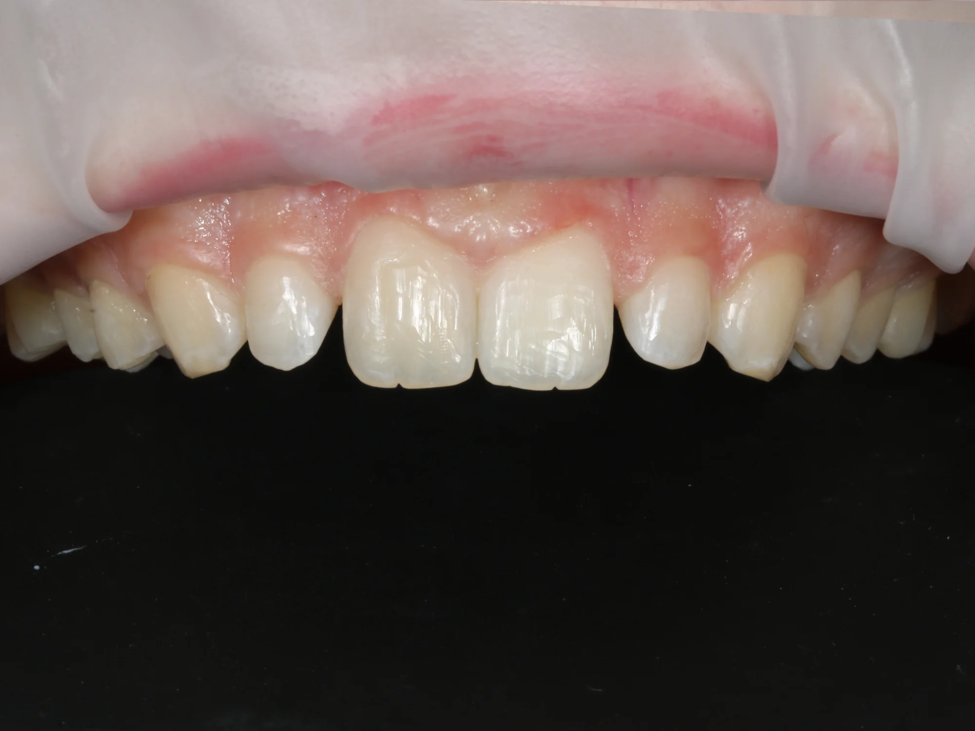 Close-up of upper front teeth showing uneven edges, discoloration, and spacing.
