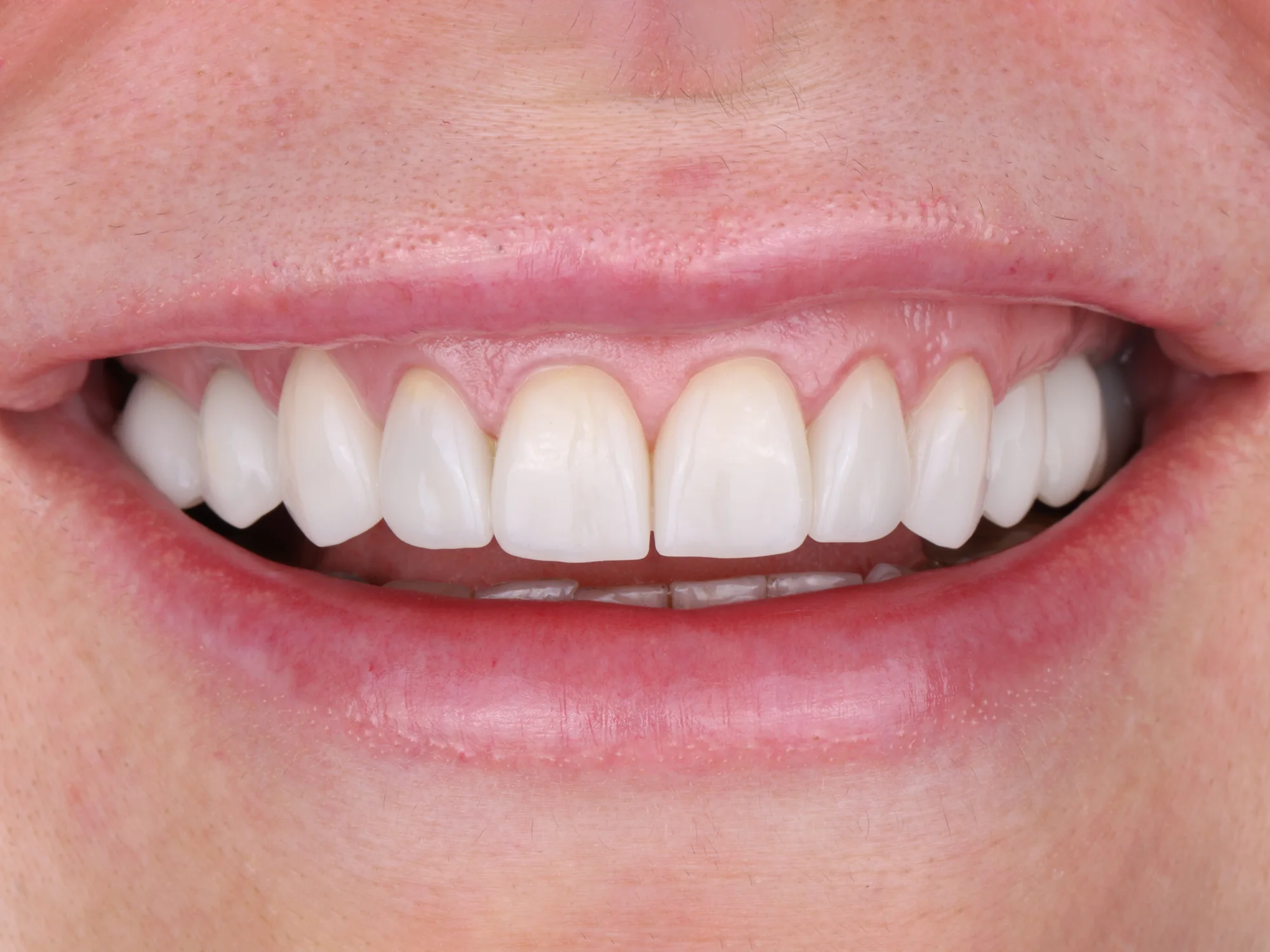 Close-up of a bright, even smile after porcelain veneers at Mississauga Smiles Dentistry.