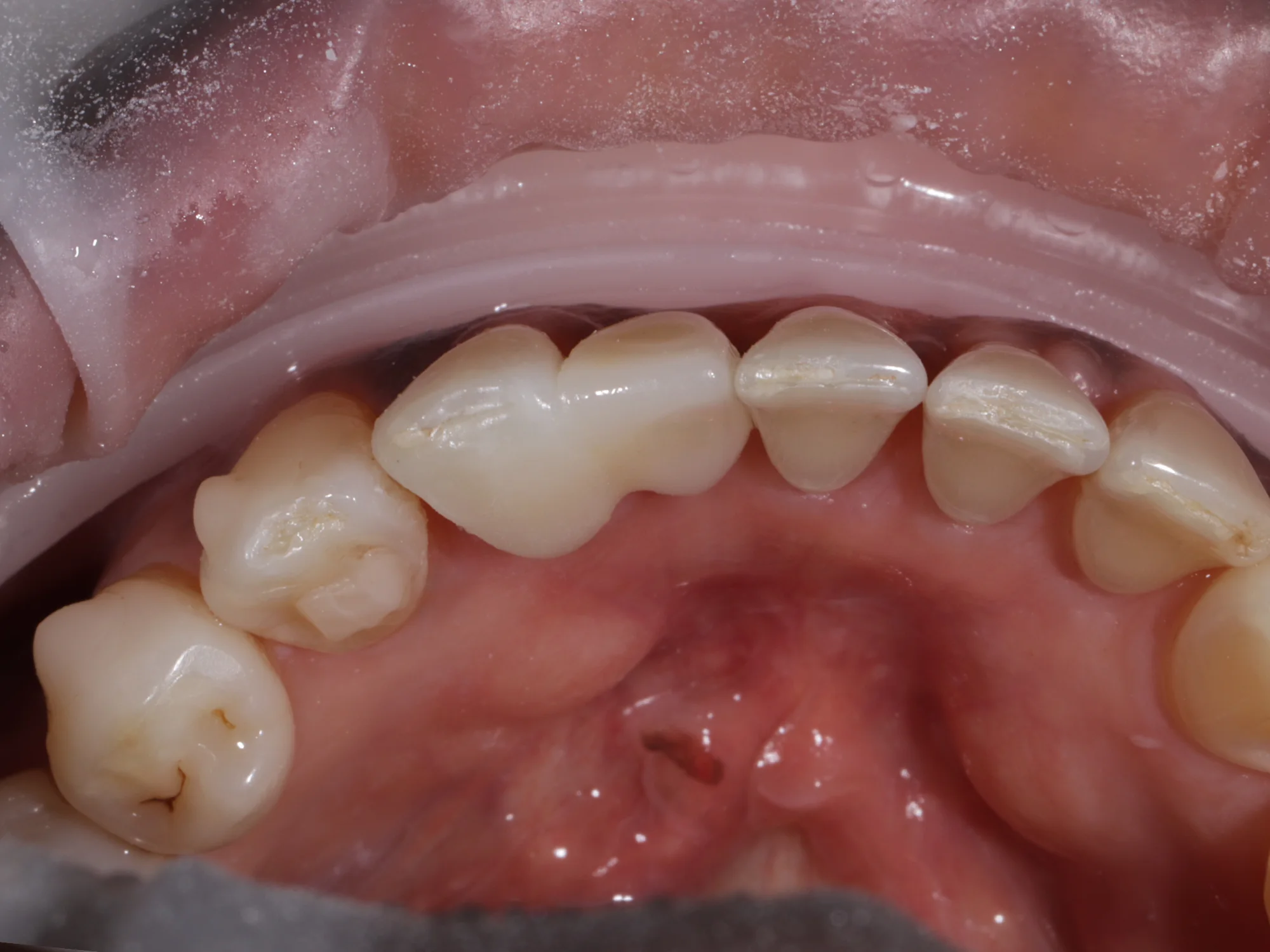 Teeth after same-day crown and veneer treatment at Mississauga Smiles Dentistry.