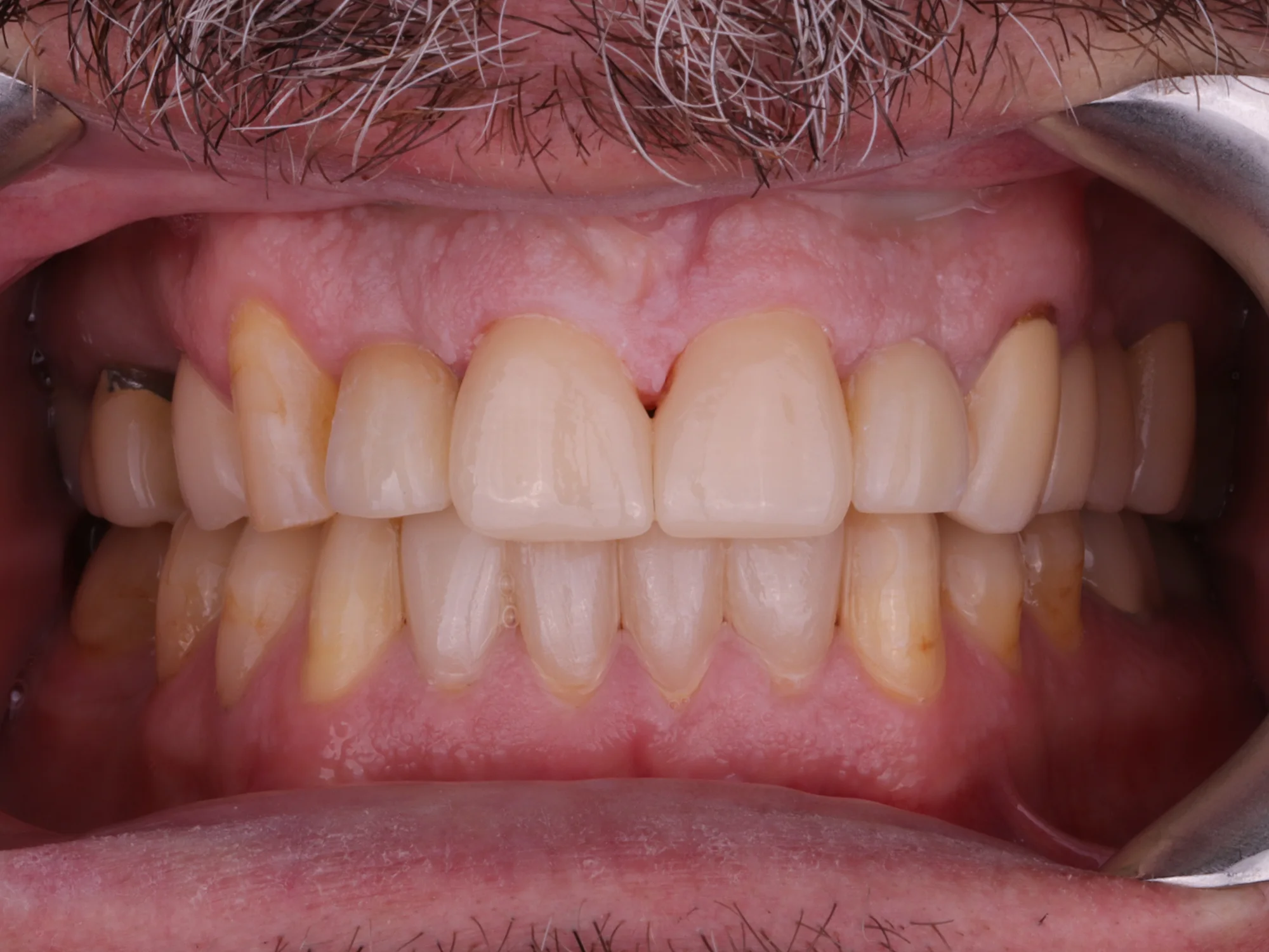 Close-up of teeth after cosmetic dental treatment with veneers or same-day crowns