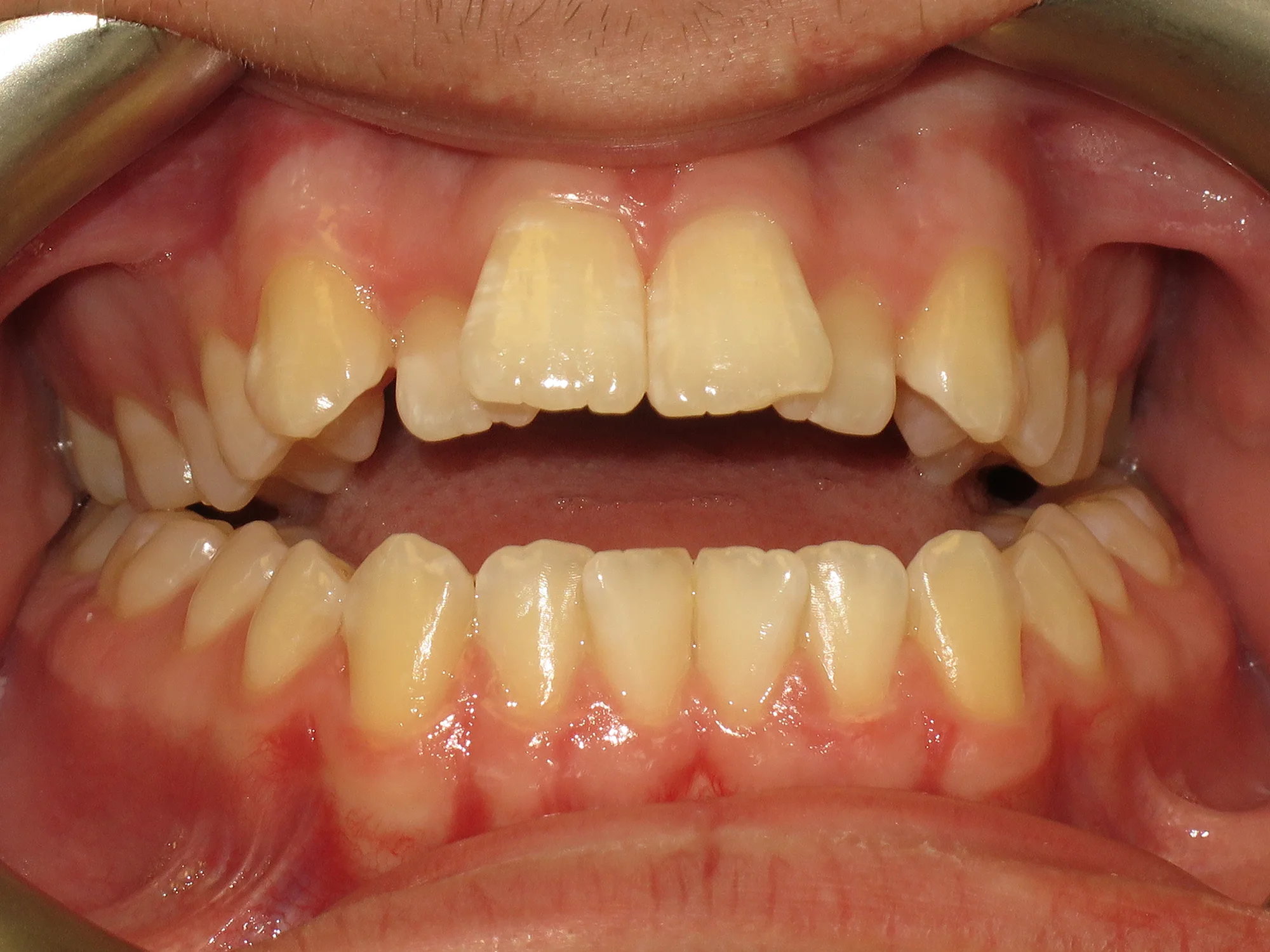 Close-up of upper teeth with protruding central incisors and tilted adjacent teeth