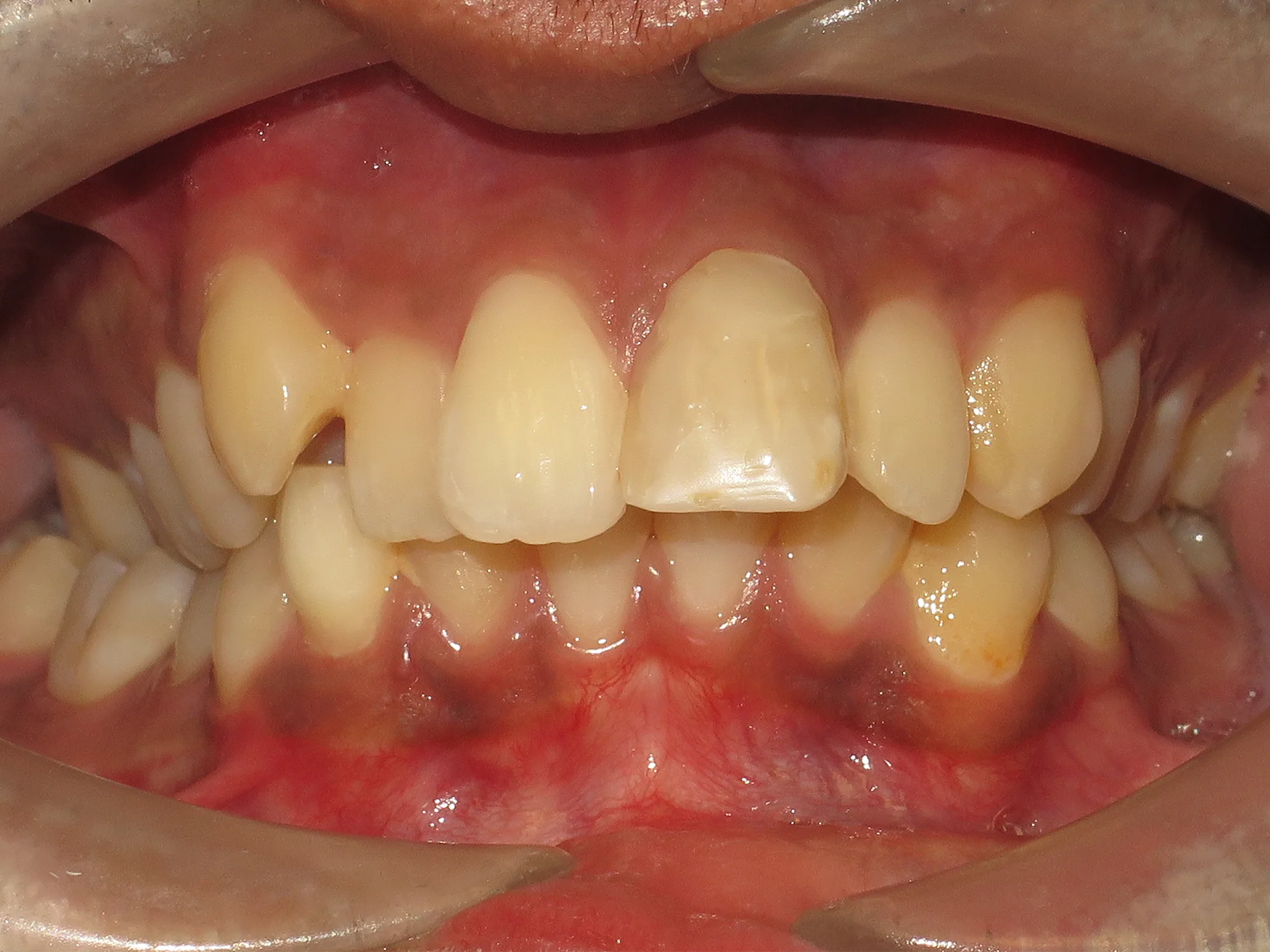 Close-up of crowded and misaligned teeth before starting braces treatment