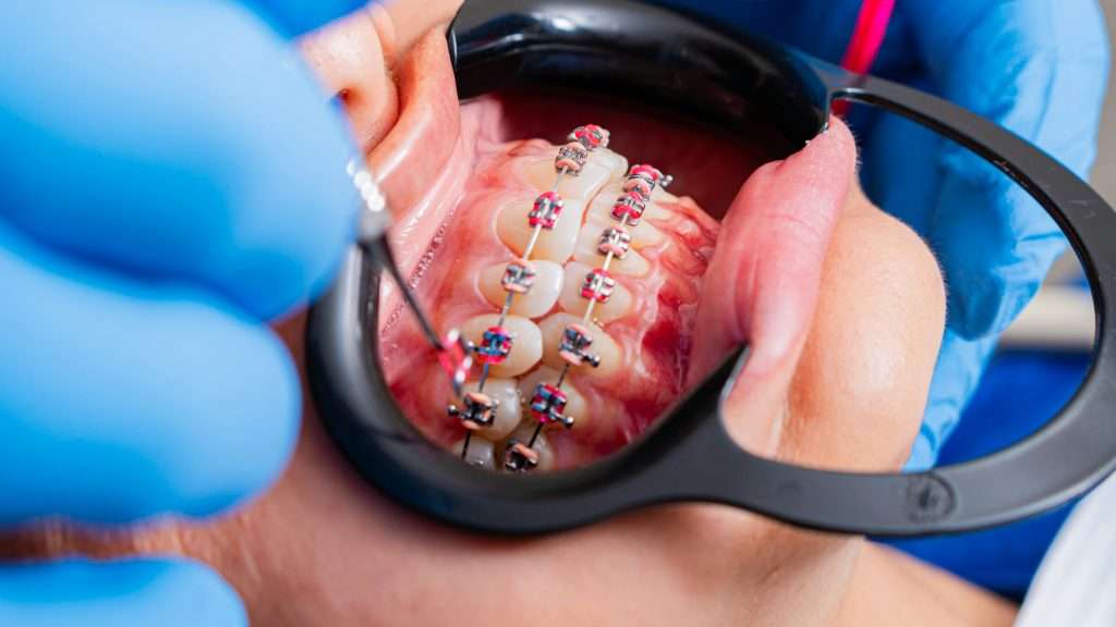 A dentist adjusting braces on a patient's teeth with dental tools.