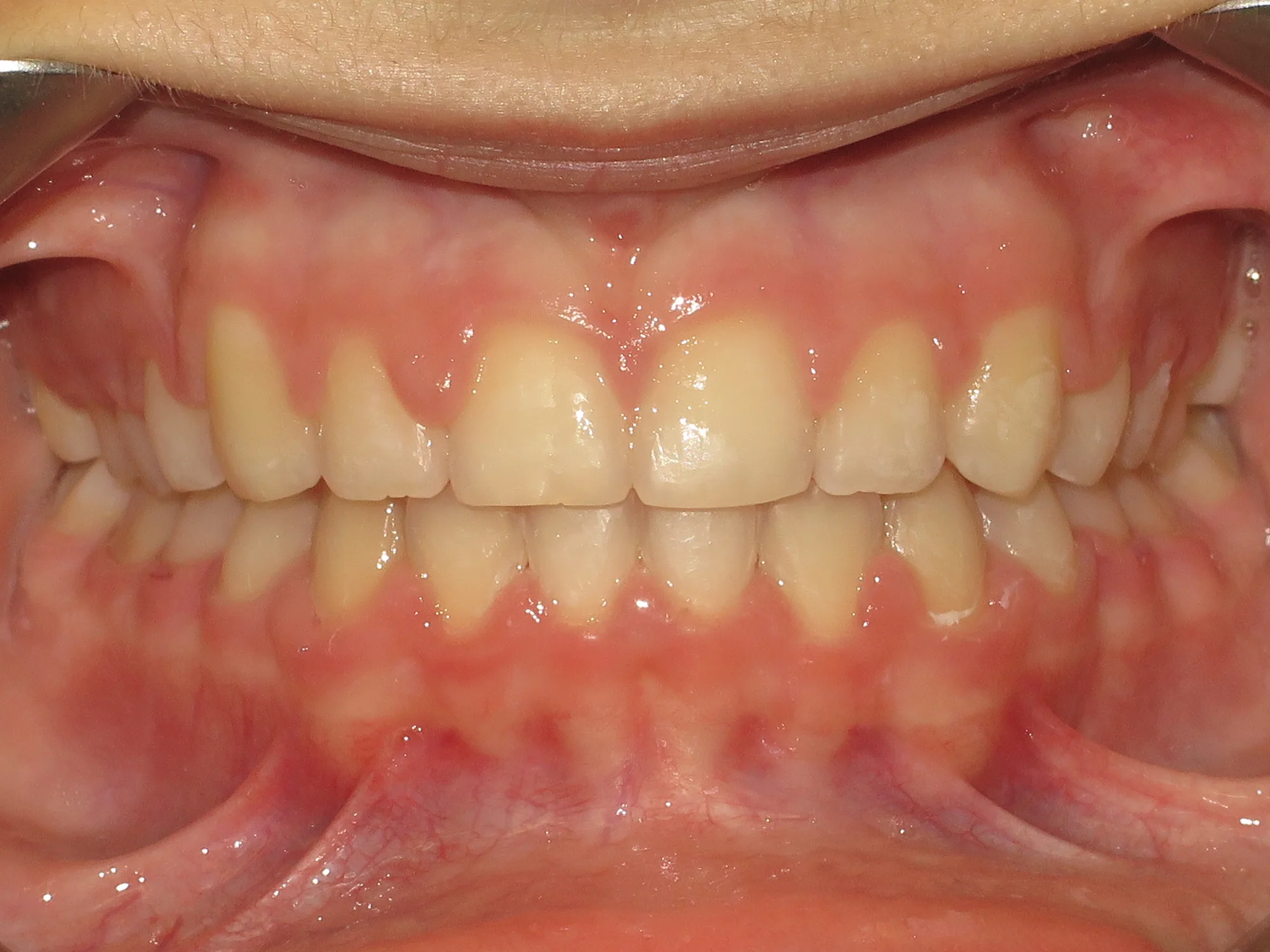 Teeth properly aligned with a smooth, even smile after braces treatment