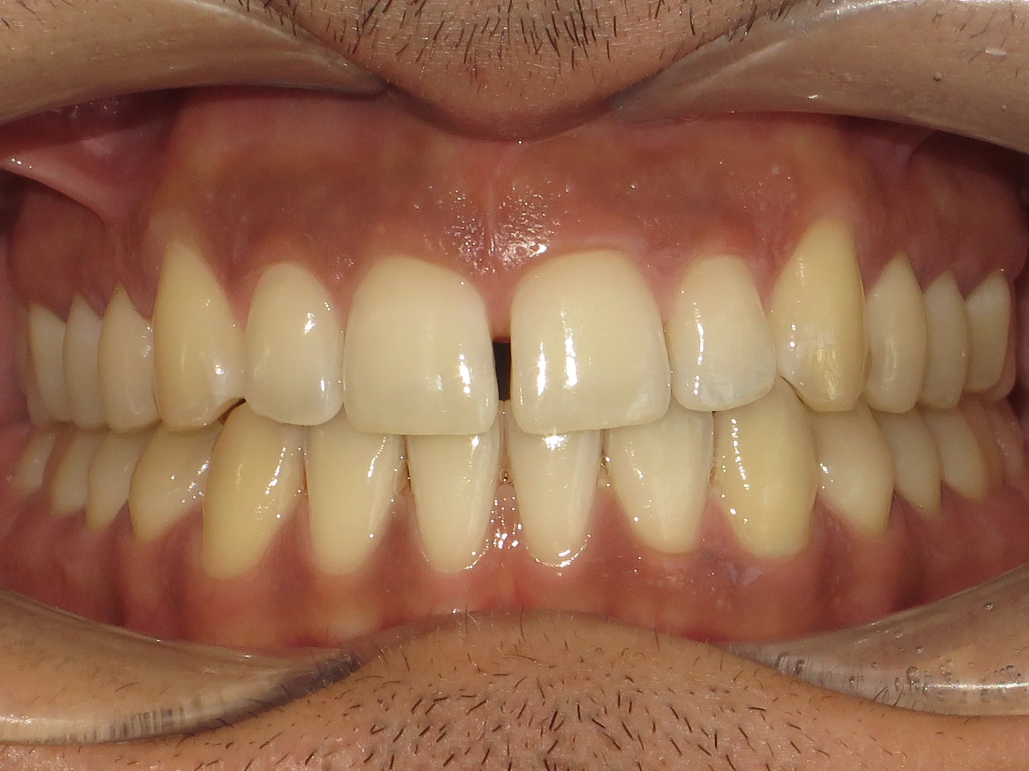 Close-up of upper teeth showing a visible gap between the two front teeth