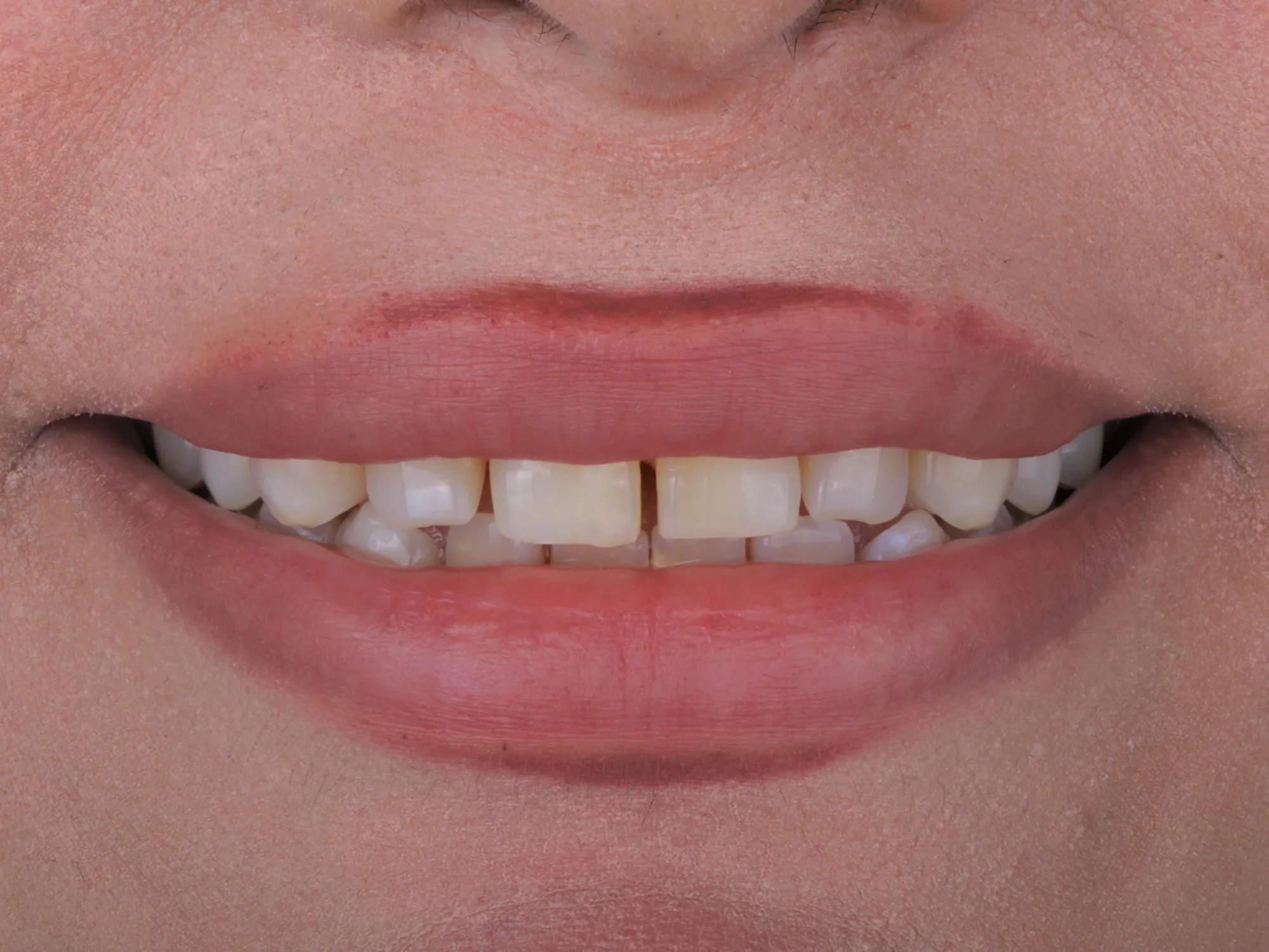 Teeth with a slight gap in the upper row, showing potential for improvement