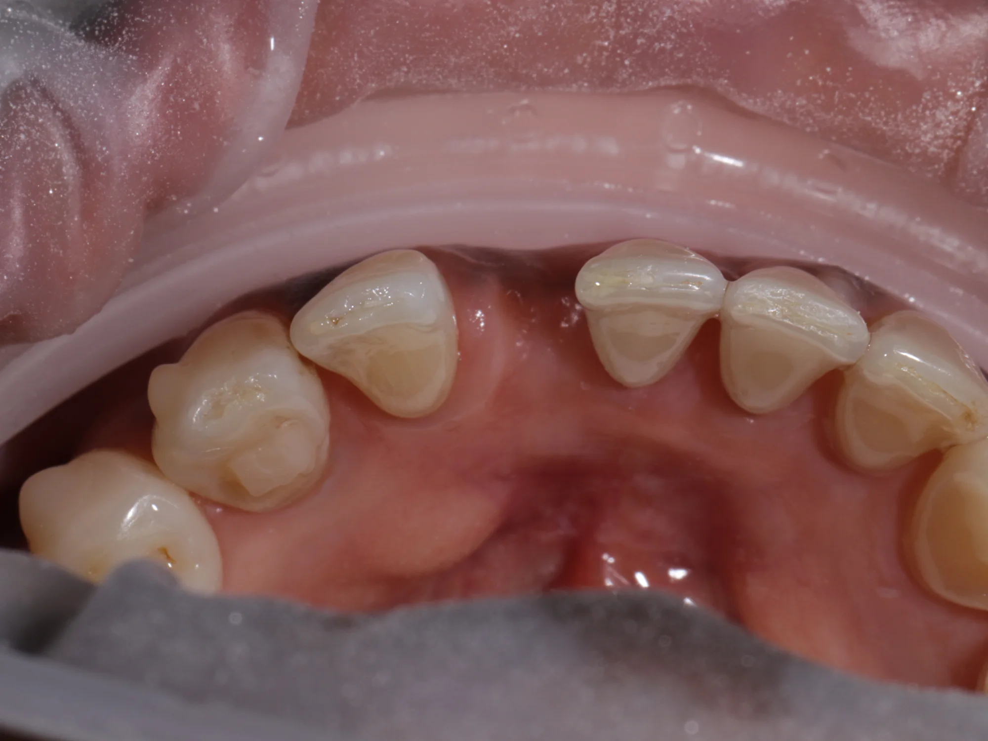 Close-up of prepared teeth for same-day crown or veneer treatment at Mississauga Smiles Dentistry.