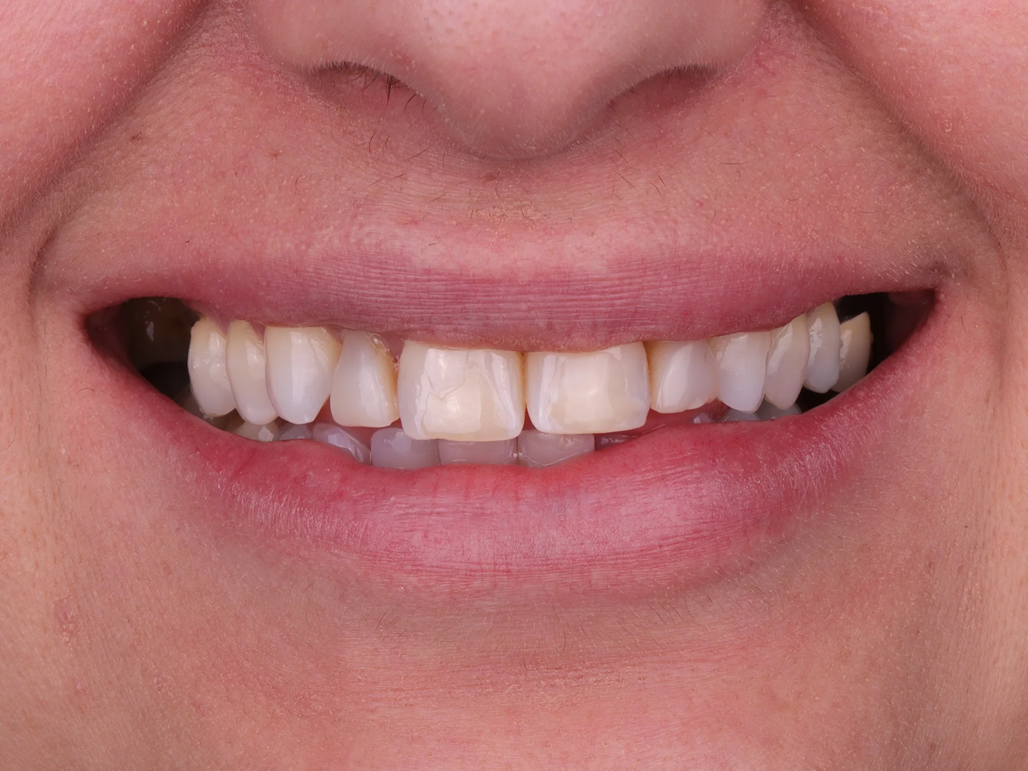 Misaligned and Dull Upper Teeth Before Porcelain Veneer Treatment