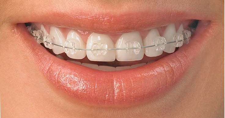 Close-up of teeth with clear ceramic braces.