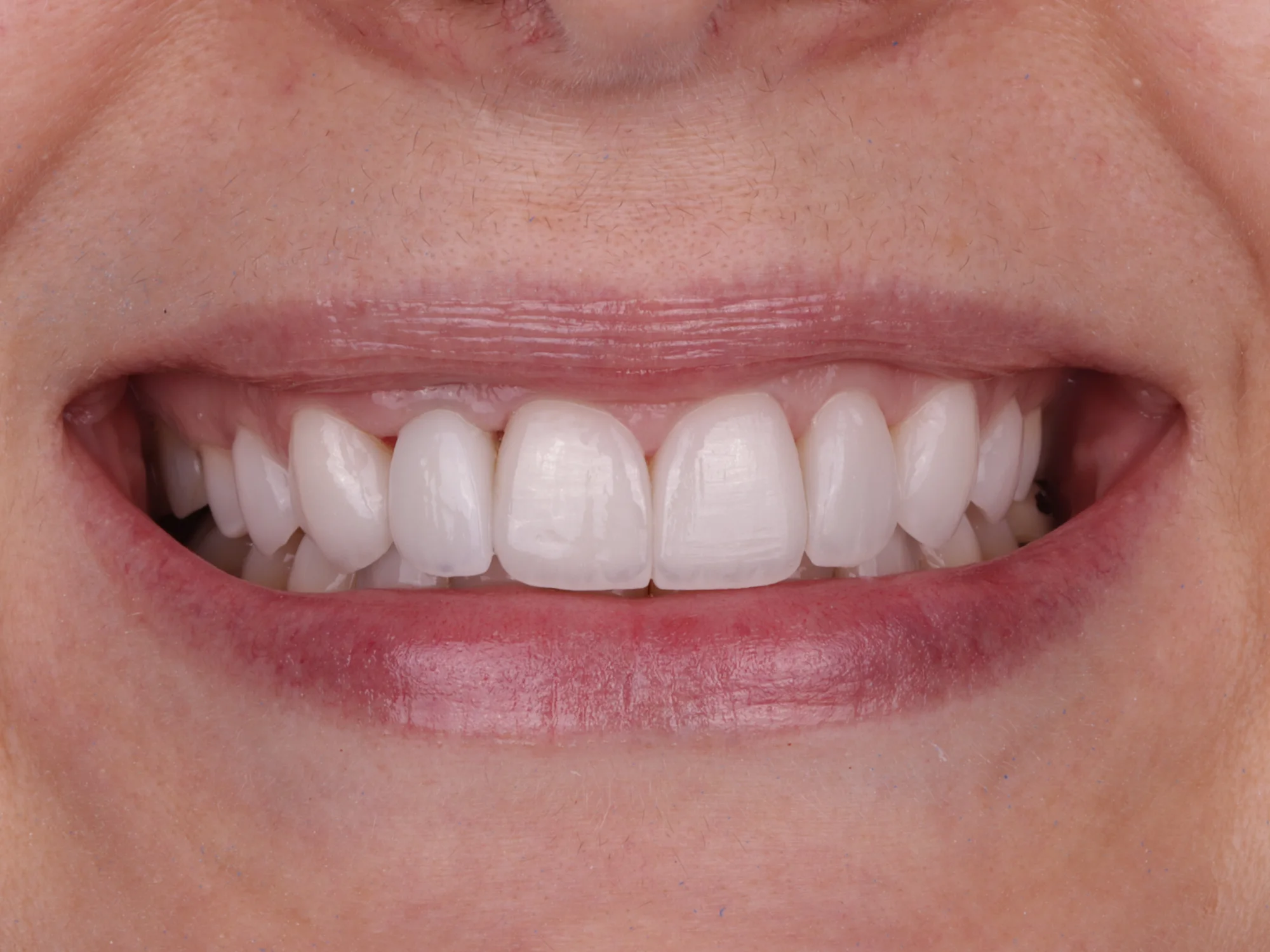 A beautifully aligned and bright smile after getting veneers, showing shaped teeth.