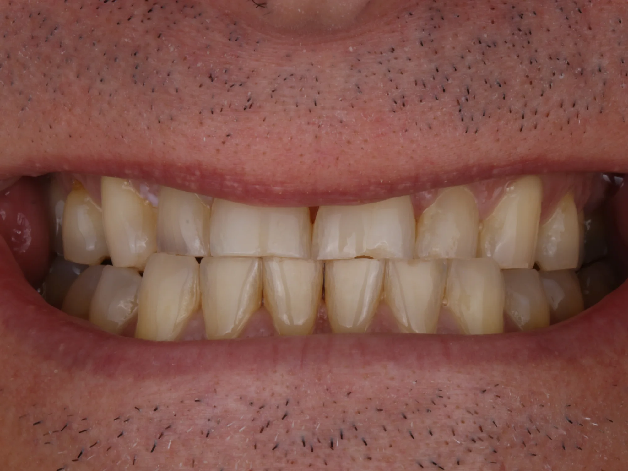 A close-up of tooth discoloration and a chipped front tooth Before the smile makeover