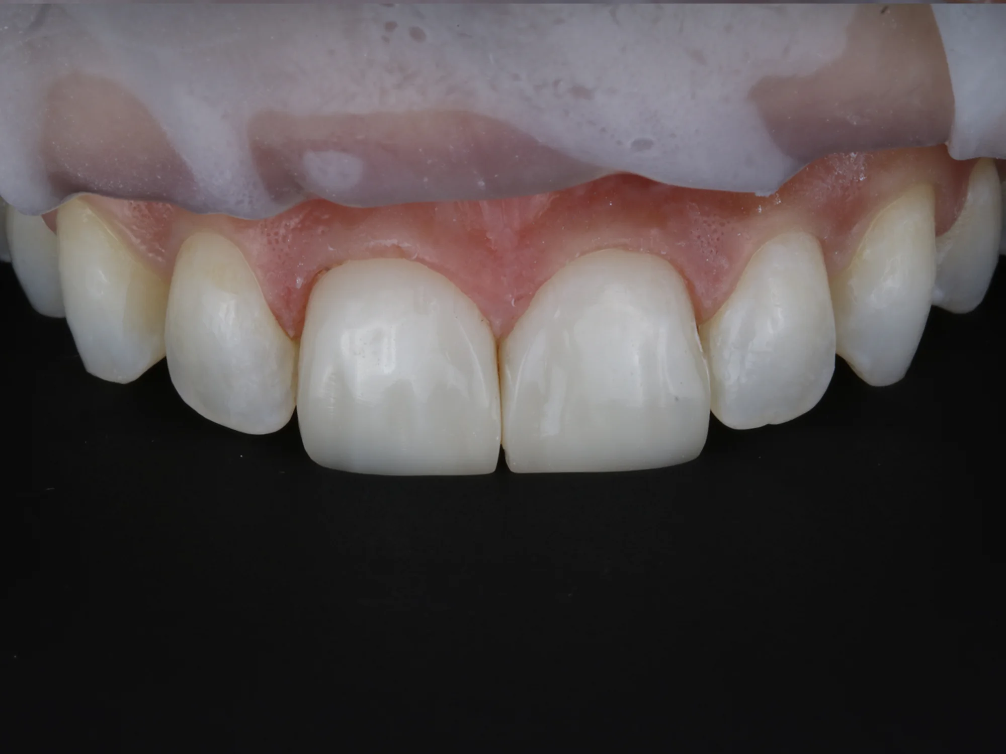 Close-up of teeth after smile makeover treatment showing bright, even, and healthy teeth.