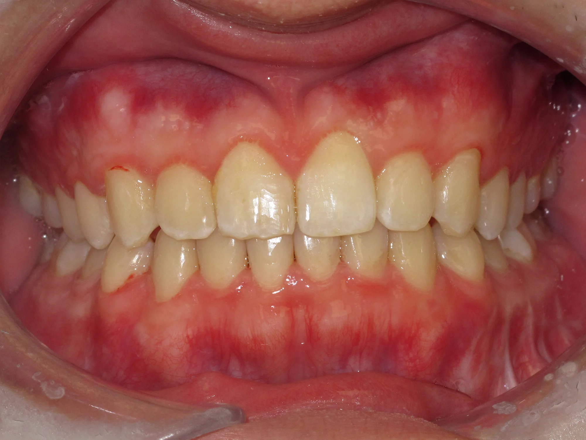 Lower front teeth perfectly aligned after Invisalign treatment