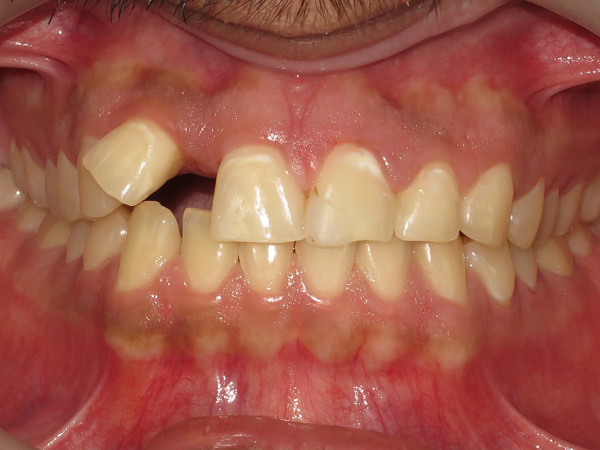 Front teeth with misalignment—one lateral incisor positioned higher than the others