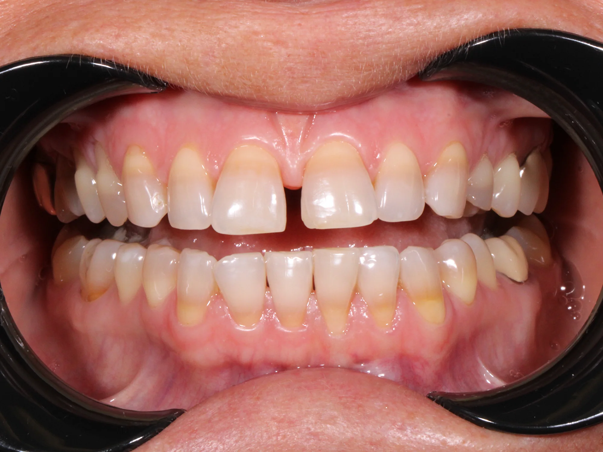 Close-up of teeth before smile makeover showing discoloration and uneven edges