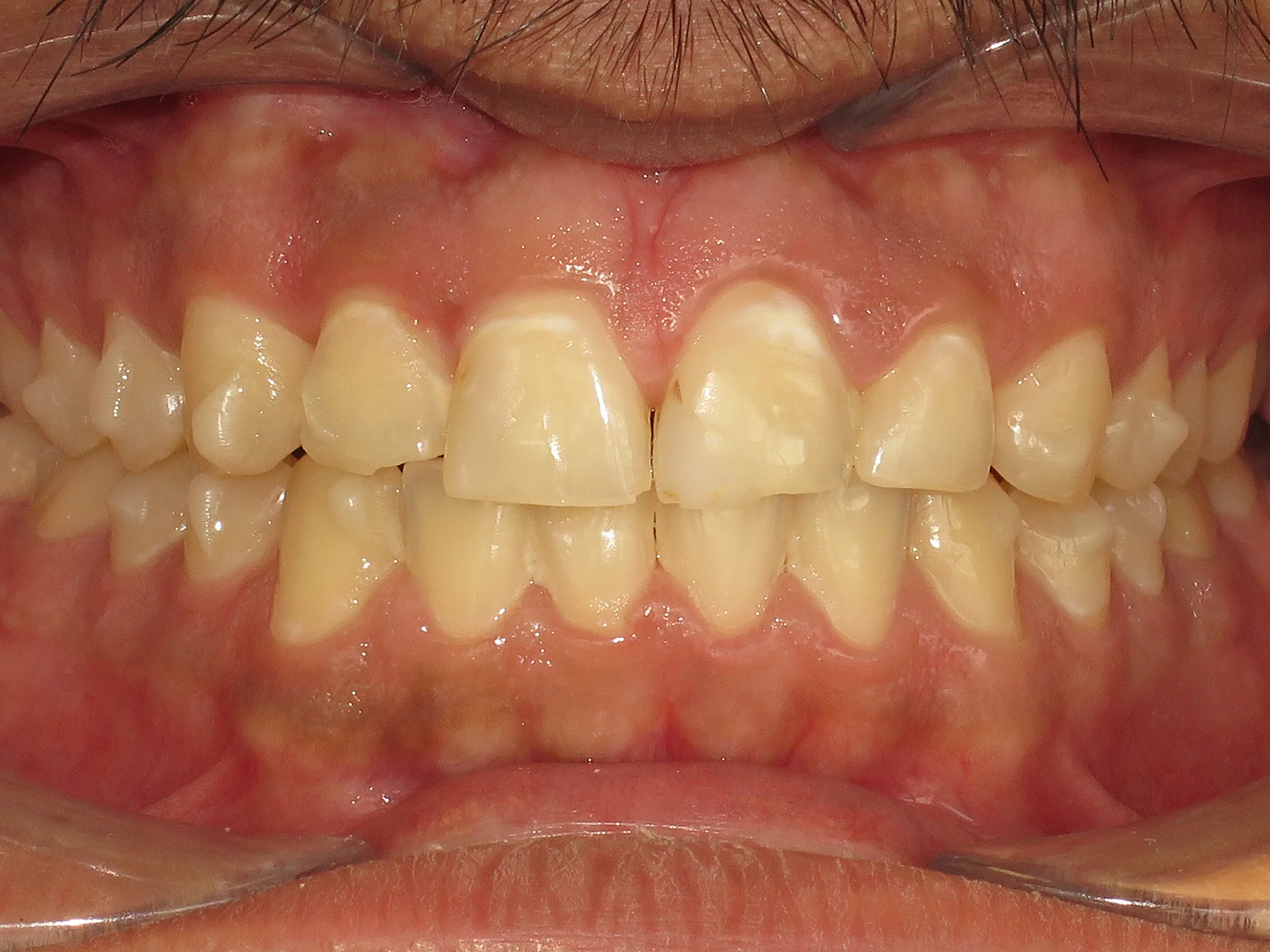 Straight upper front teeth after Invisalign treatment with perfect alignment.