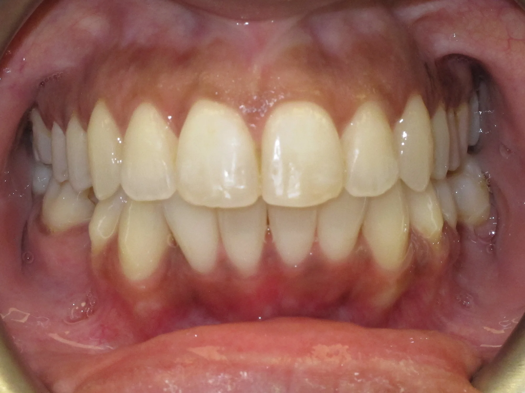 Close-up of aligned upper and lower teeth after Invisalign treatment
