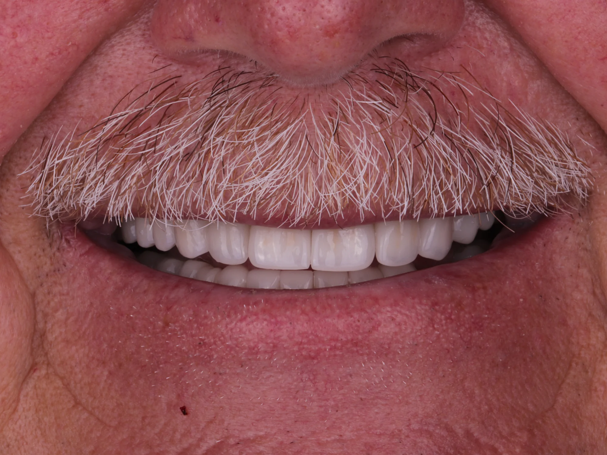 Close-up of a smile after porcelain veneers, showing even, white, and healthy-looking teeth.