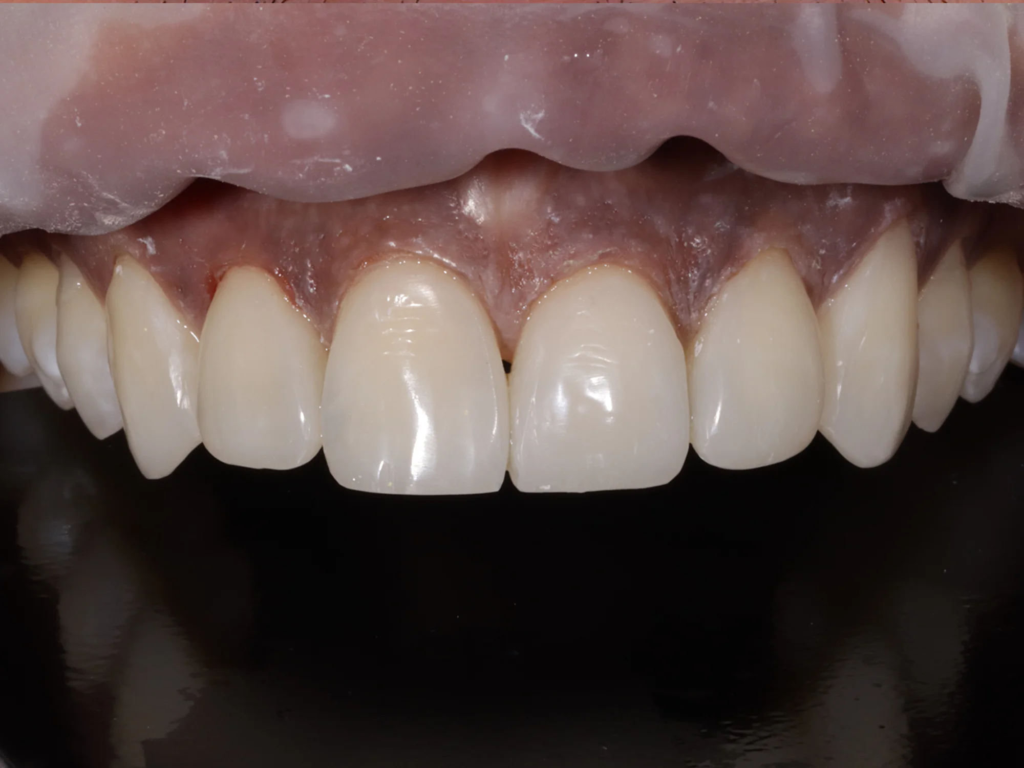 Perfectly restored front teeth after smile makeover at Mississauga Smiles Dentistry
