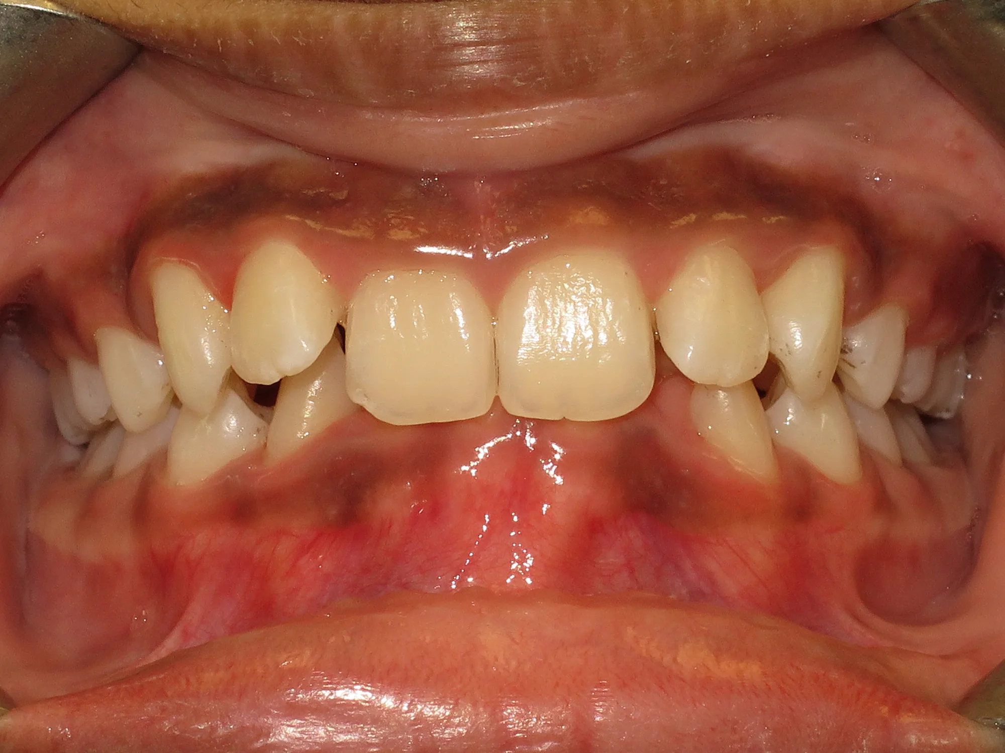 Lower front teeth pushed inward and covered by upper teeth—needs braces.