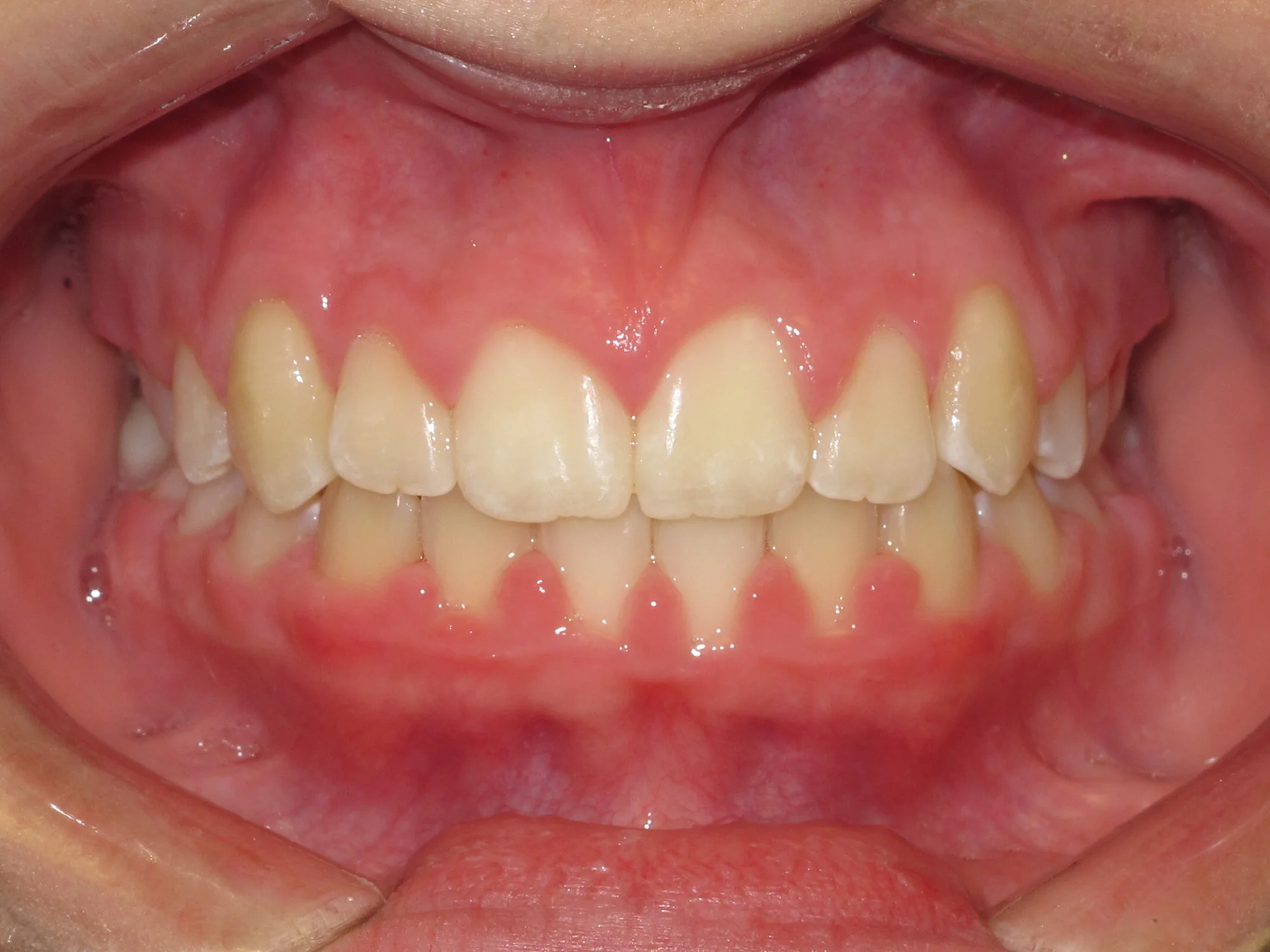 Close-up of straight, aligned teeth after successful treatment with braces.