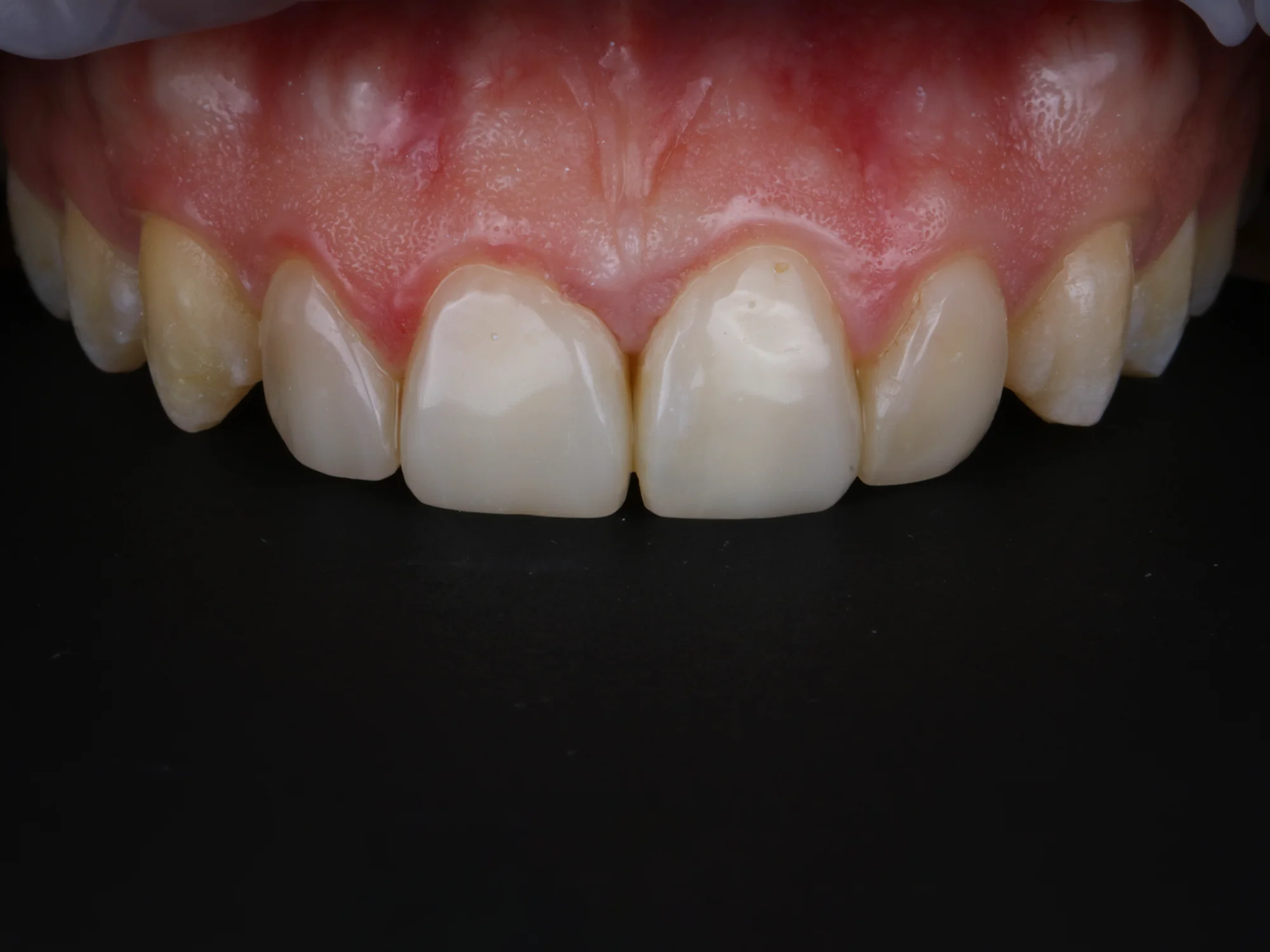 Close-up of upper front teeth after cosmetic treatment, perfectly aligned surfaces