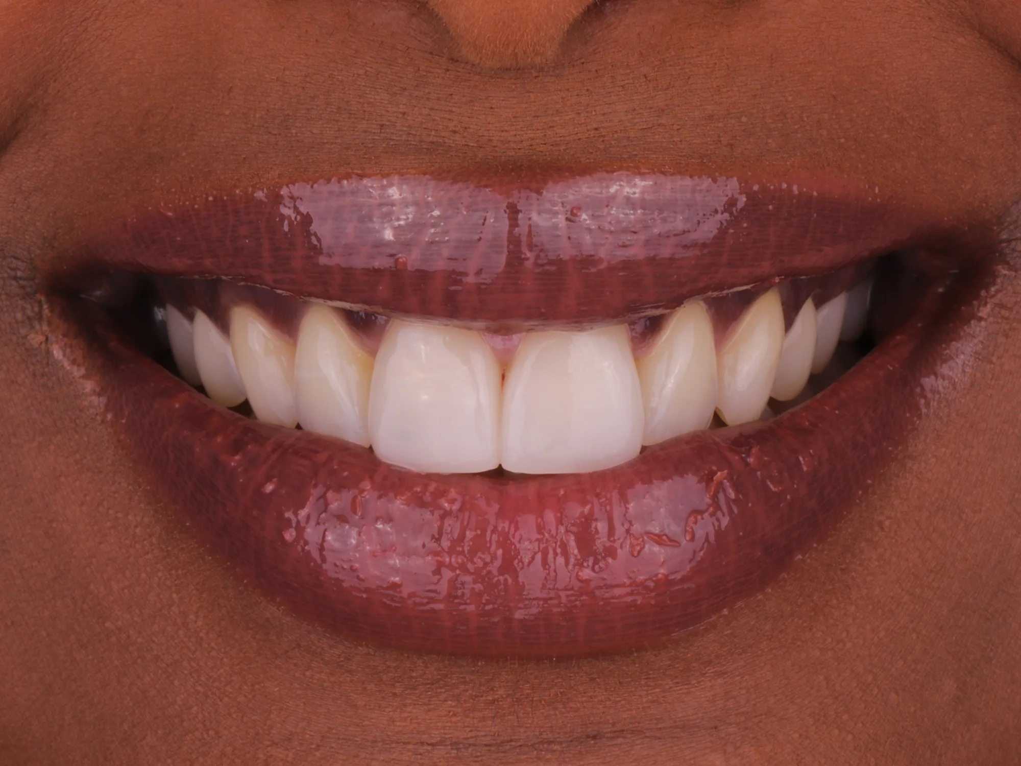 Natural smile after Same day Crown - Veneer treatment at Mississauga Smiles Dentistry