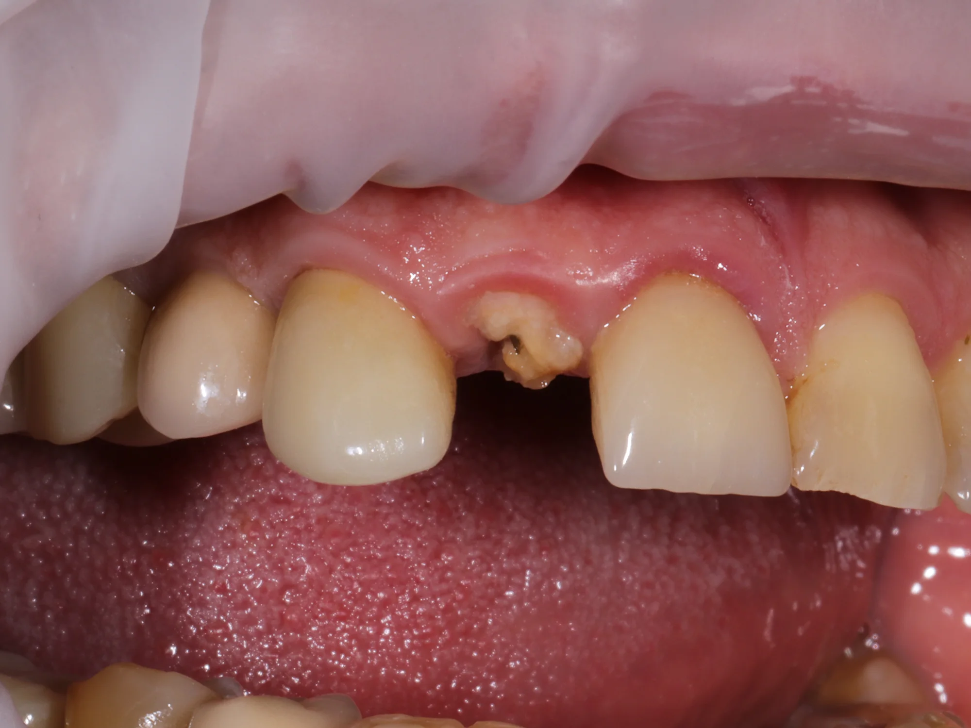Decayed front tooth with enamel loss and gum recession