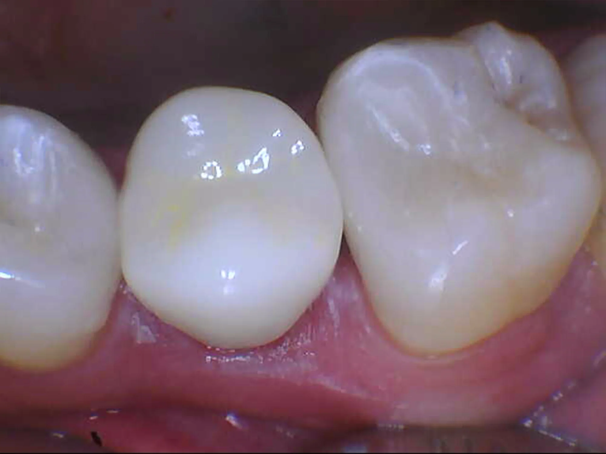Restored molars with SamedayCrownVeneer at Mississauga Smiles Dentistry