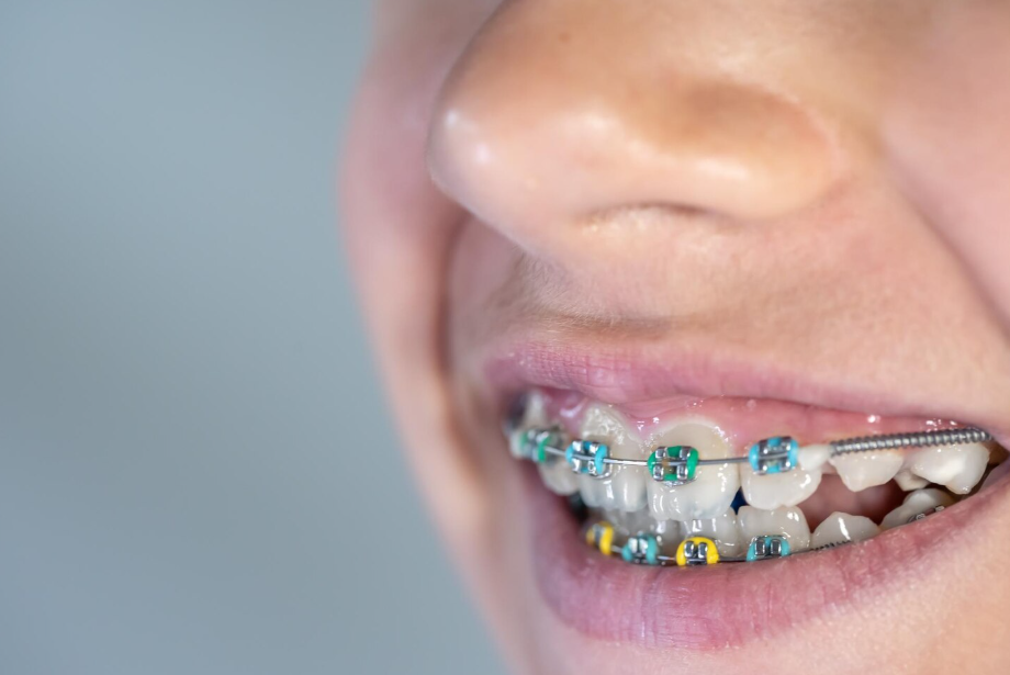 Close-up of a child wearing braces, showing early orthodontic care for kids.