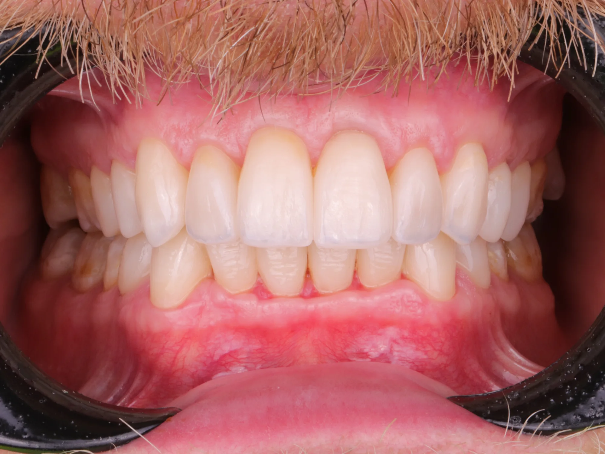 Bright, aligned teeth after porcelain veneers