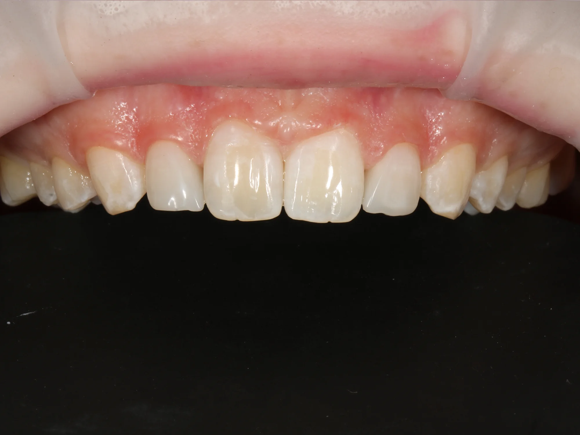 Close-up of teeth after smile makeover with aligned, contoured shape and improved aesthetics.