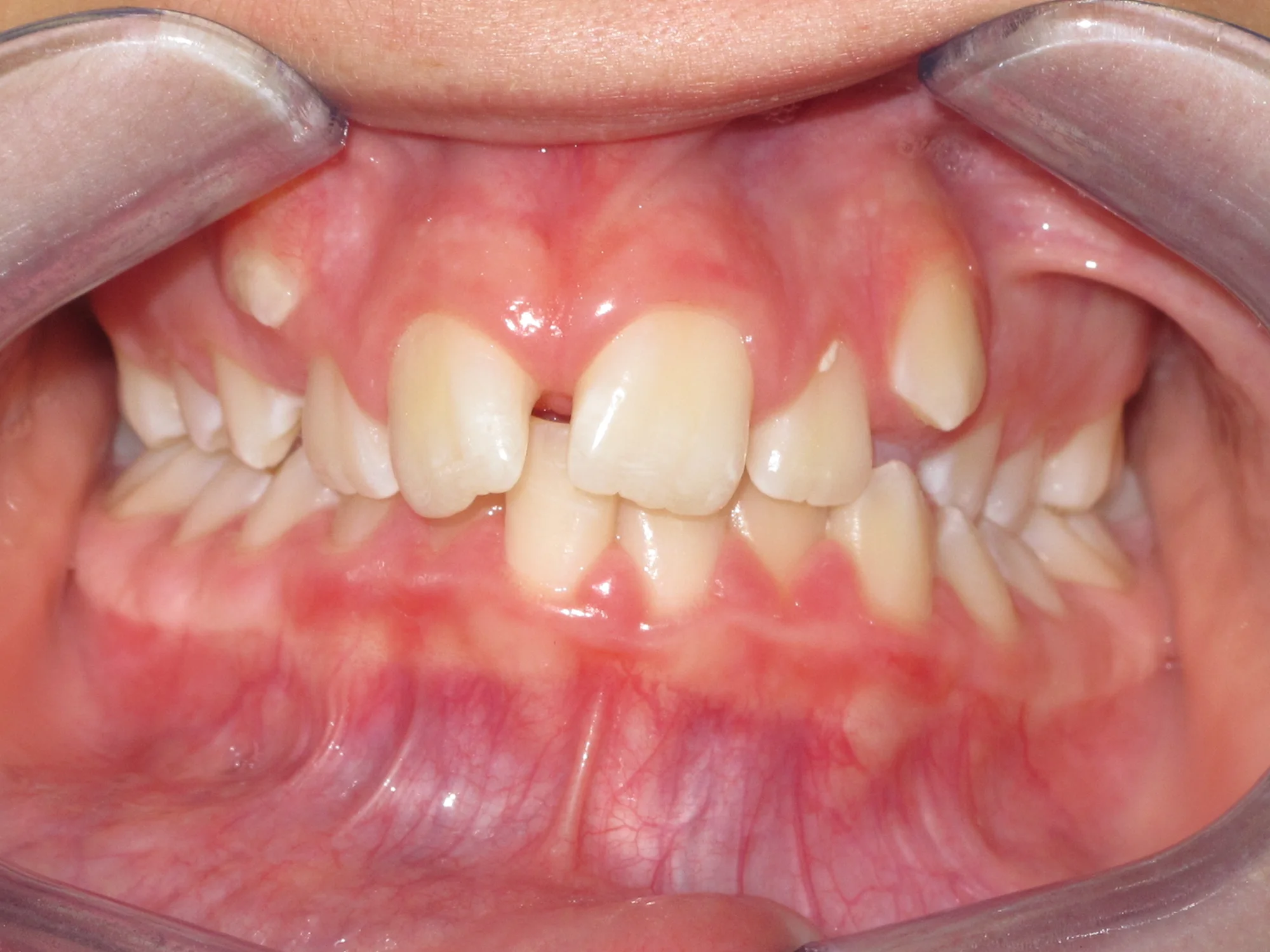 Close-up of misaligned teeth and dental crowding before treatment with braces.