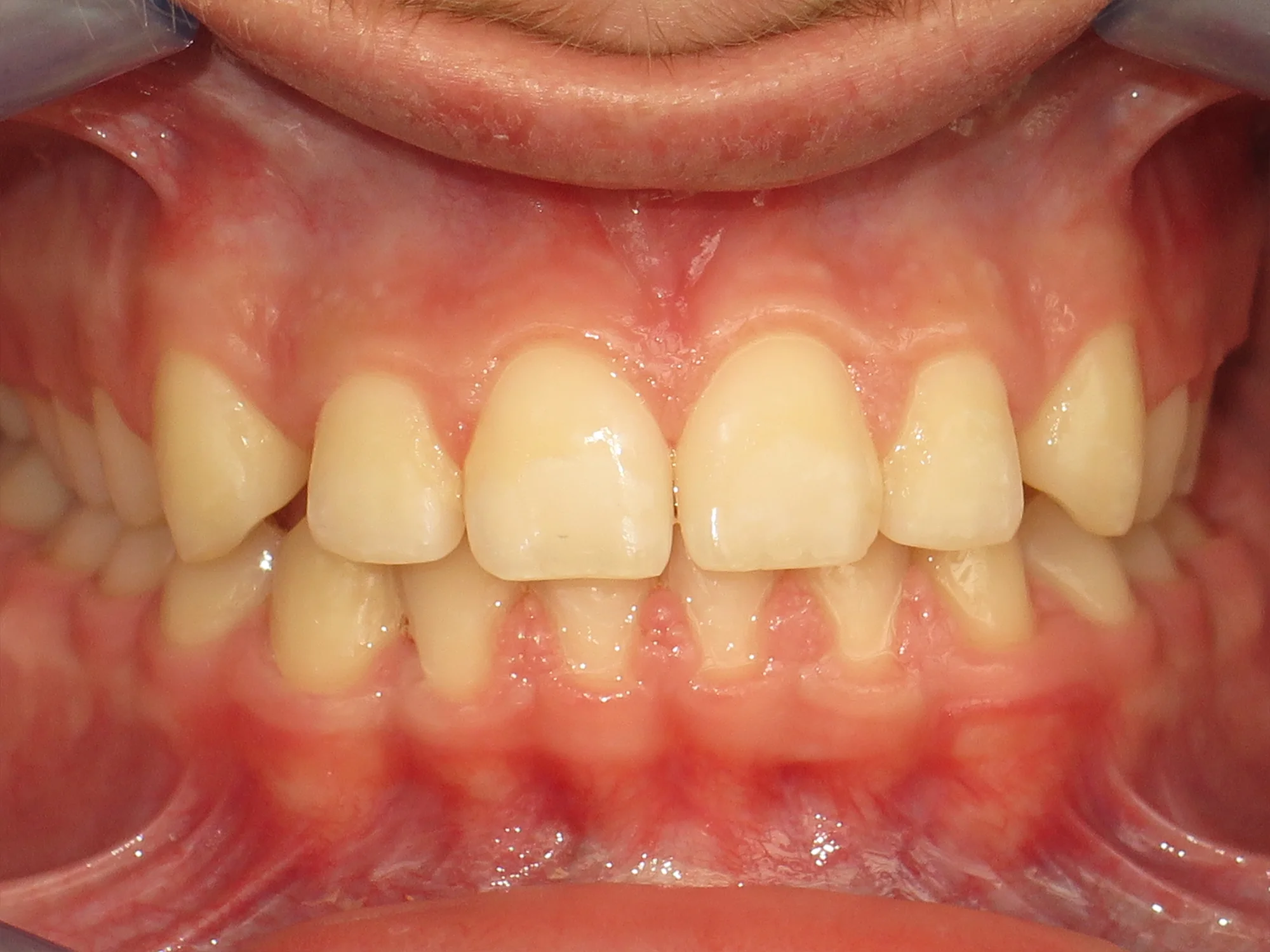 Close-up of perfectly aligned teeth after orthodontic braces treatment