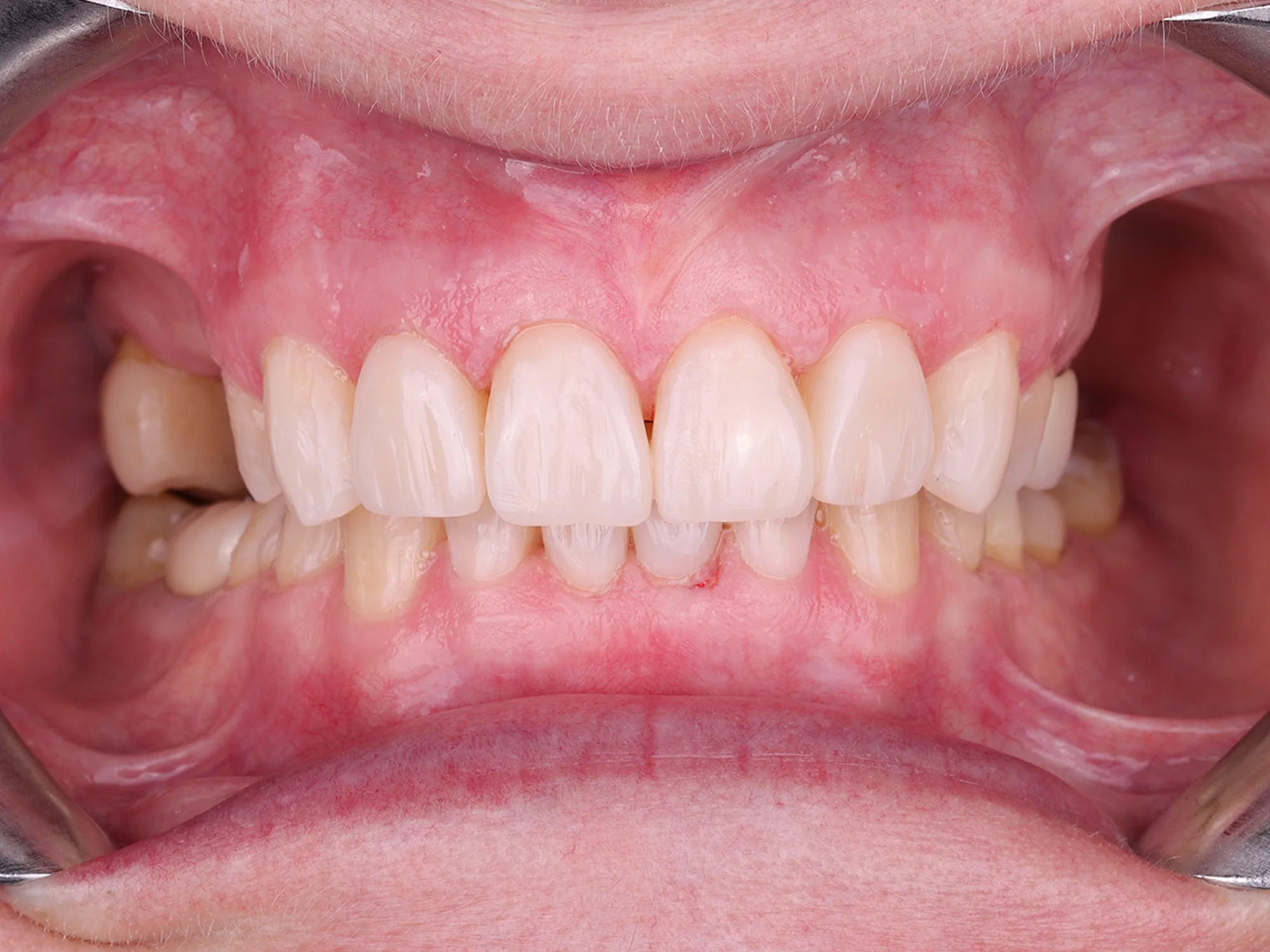 Perfectly aligned, white teeth with natural shine after smile makeover.