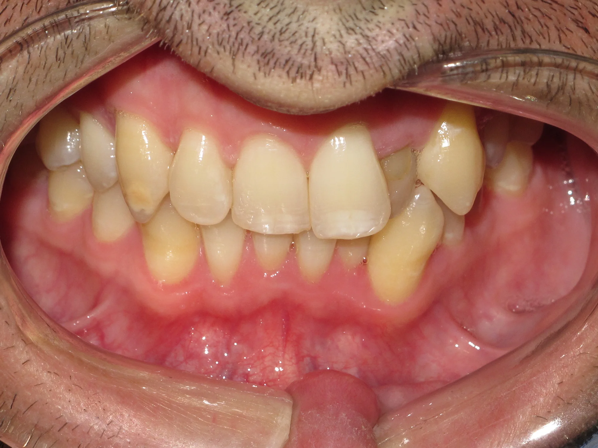 Close-up of misalignment between upper and lower teeth before Invisalign.