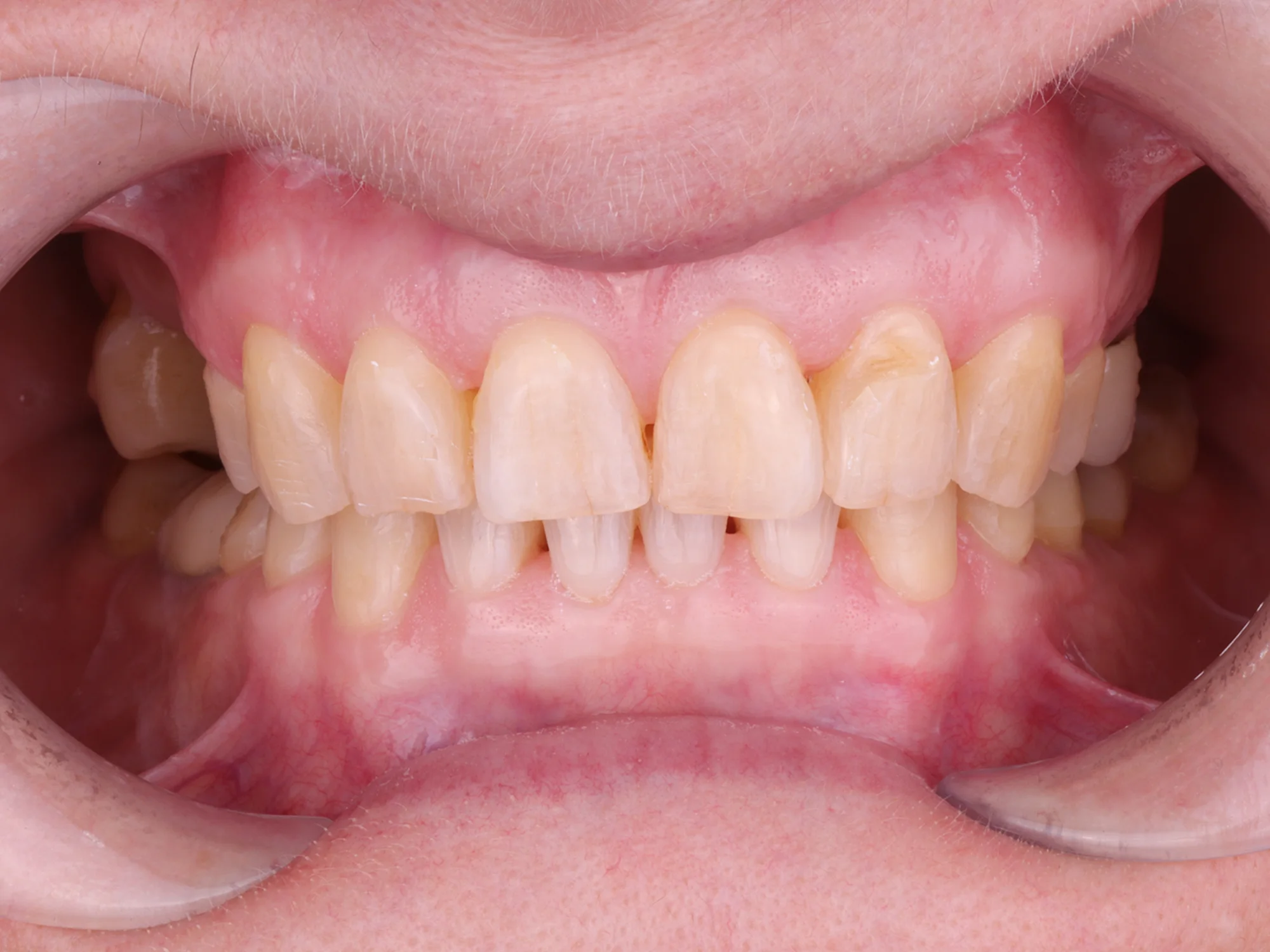 Upper and lower teeth with small gaps and discoloration
