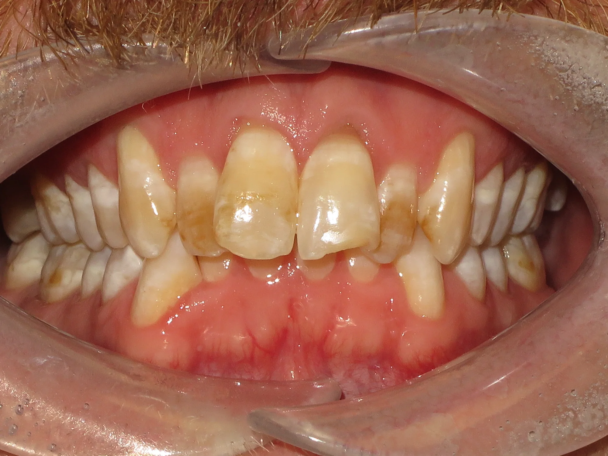 Teeth before porcelain veneers showing stains and misalignment.