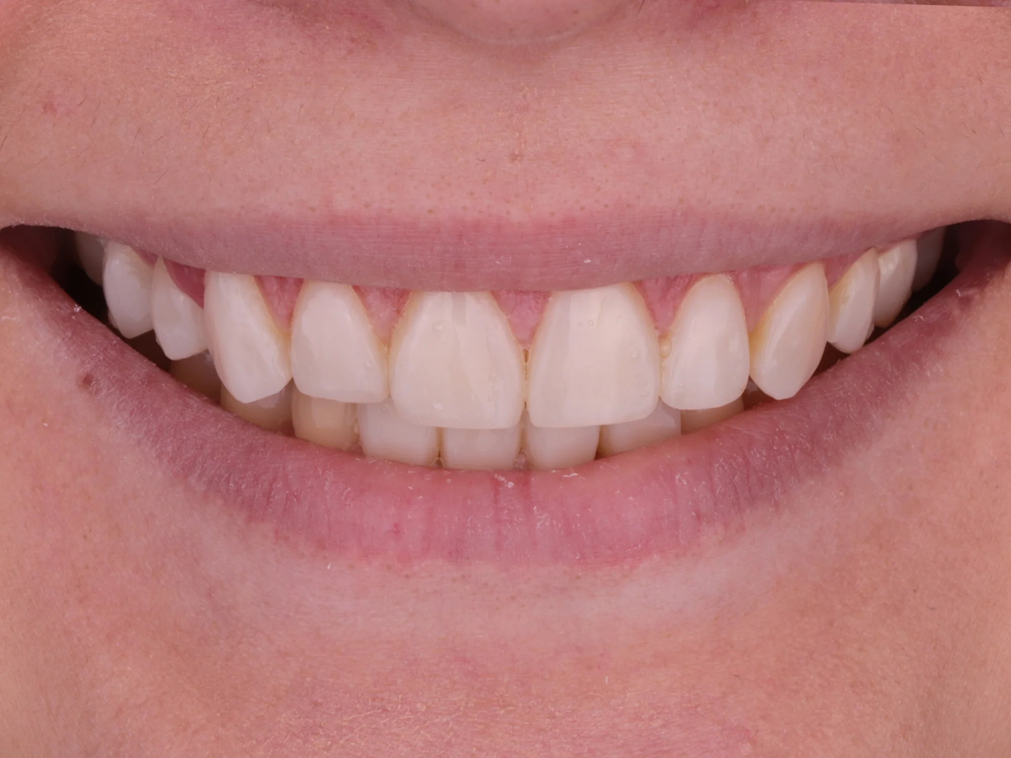 A brilliant smile after a smile makeover treatment at Mississauga Smiles Dentistry.