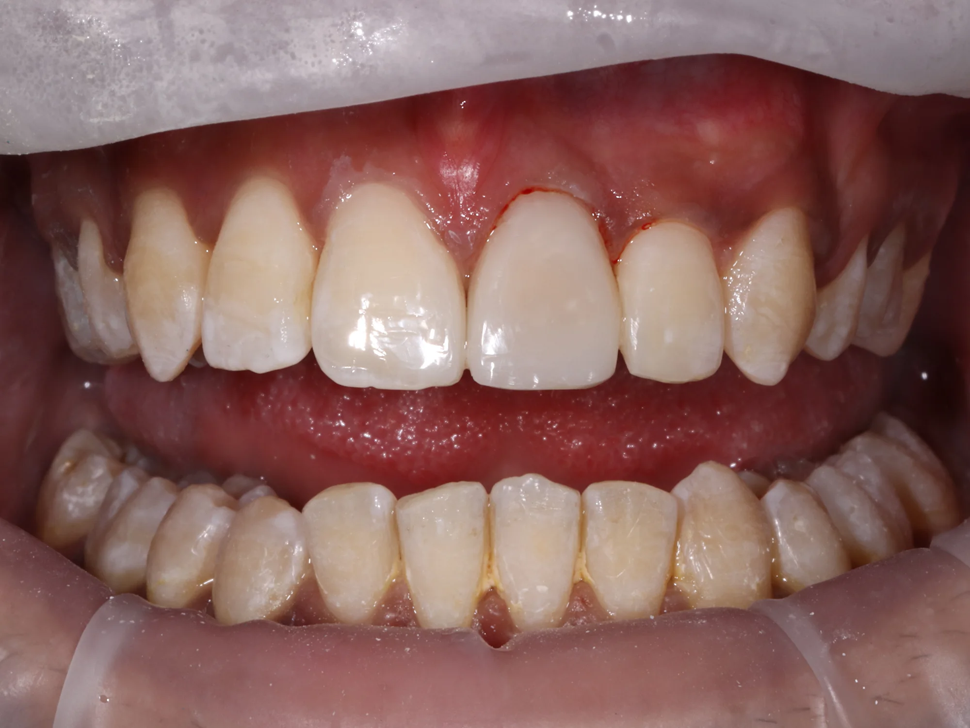 Close-up of aligned and straightened teeth after completing braces treatment
