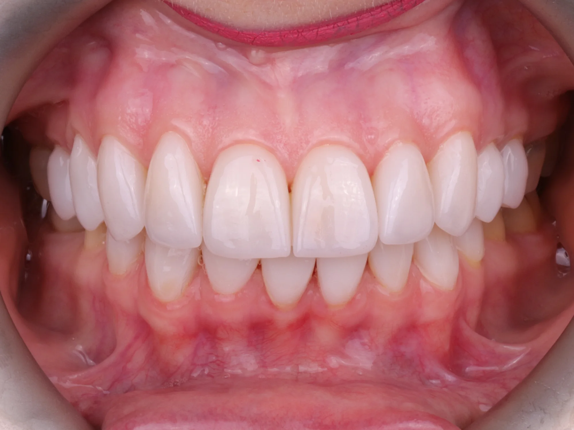 A beautifully aligned and bright smile after getting veneers, showing perfectly shaped teeth.