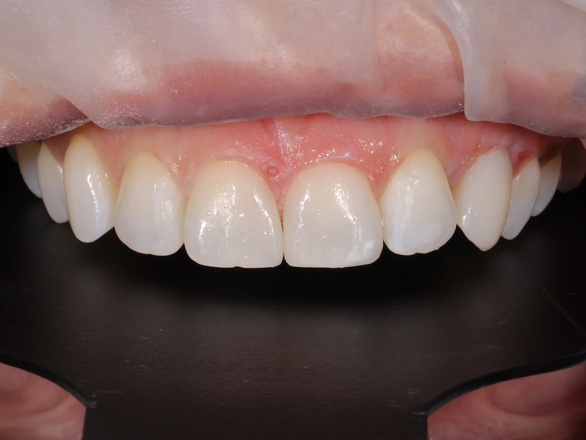 Perfectly even and aligned upper teeth after smile makeover