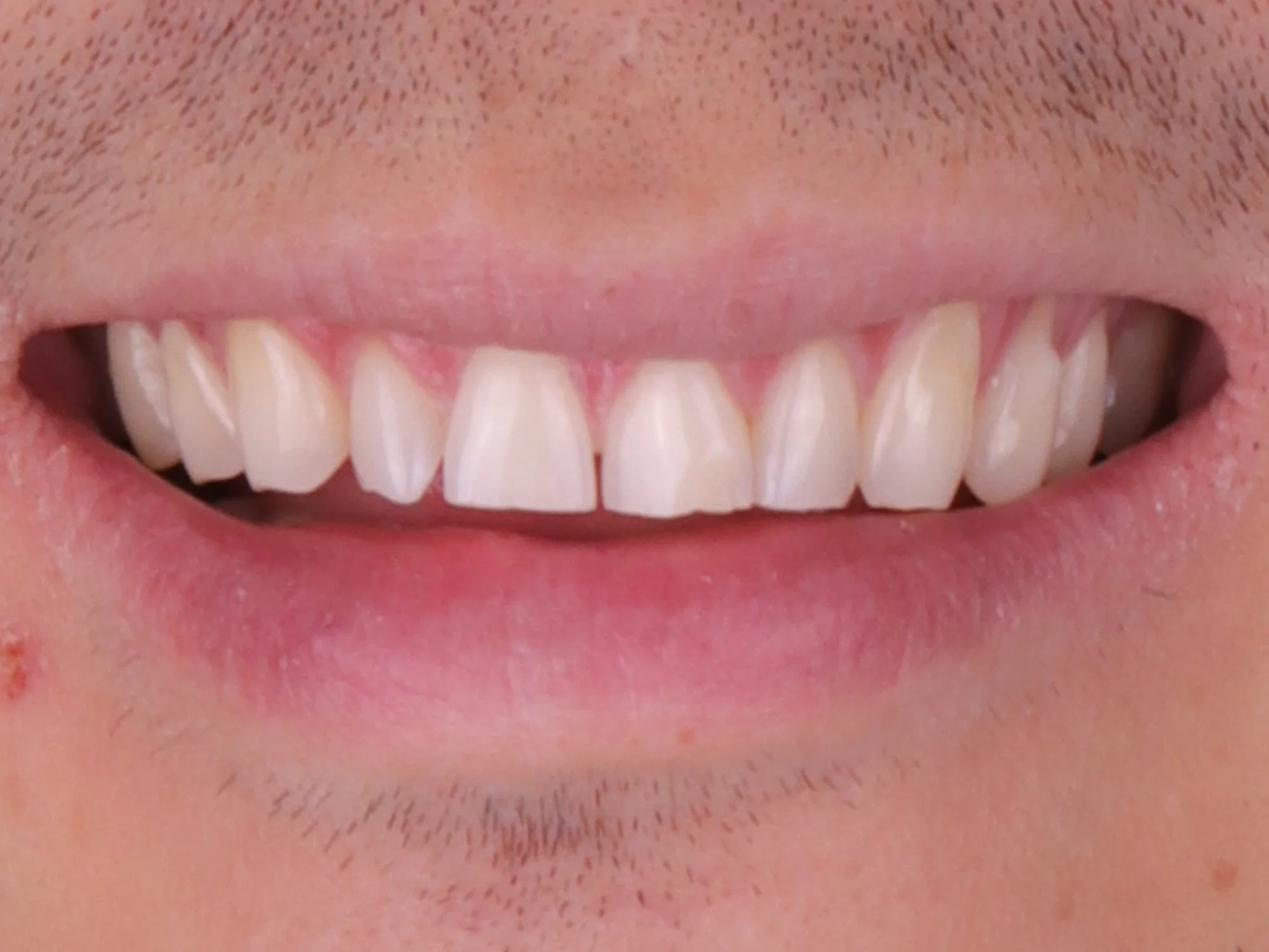 Close-up of a person's smile showing misaligned, uneven, and gapped front teeth