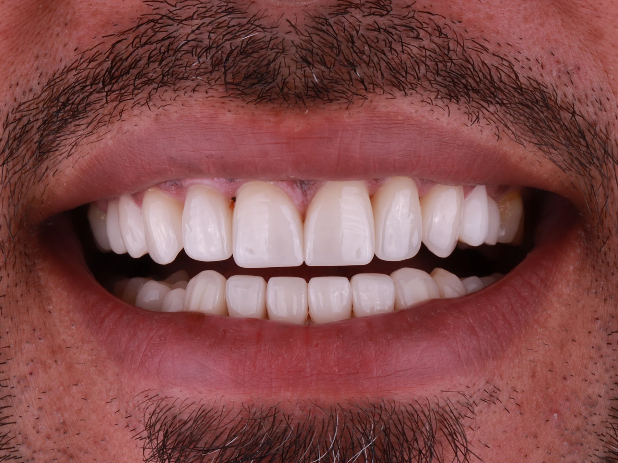 Bright and healthy smile after porcelain veneers at Mississauga Smiles Dentistry.