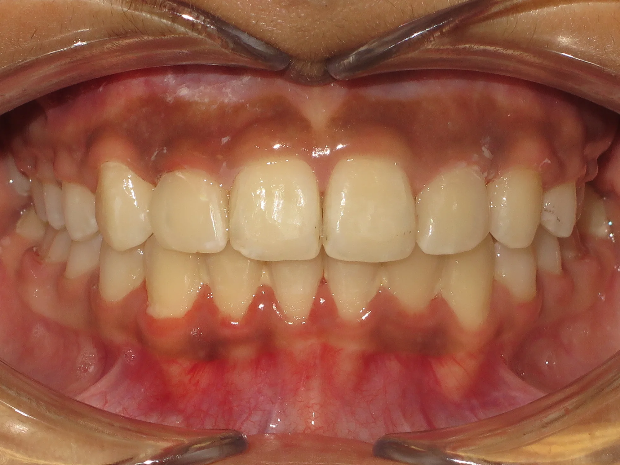 Straight, well-aligned teeth after braces treatment at Mississauga Smiles Dentistry